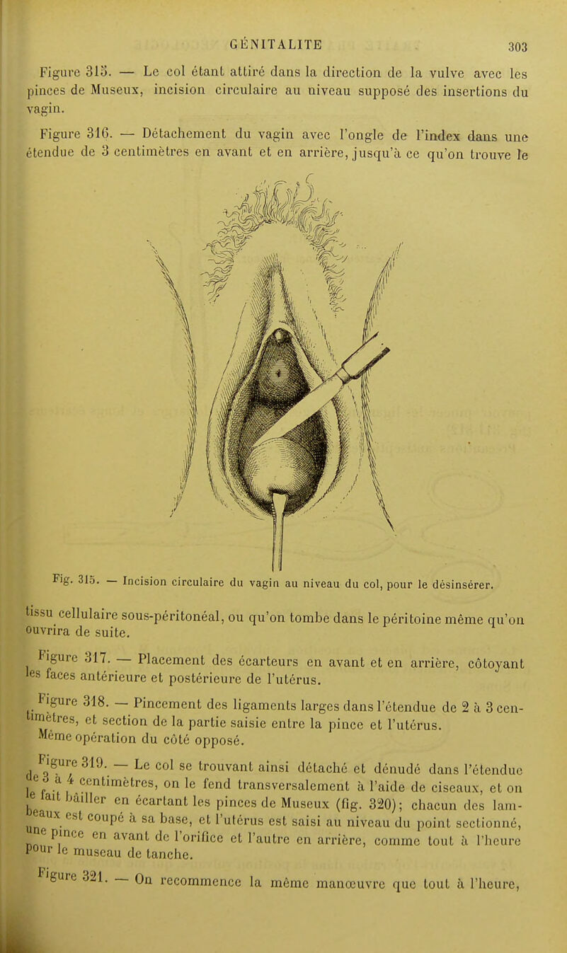 Figure 31o. — Le col étant attiré dans la direction de la vulve avec les pinces de Museux, incision circulaire au niveau supposé des insertions du vagin. Figure 316. — Détachement du vagin avec l'ongle de l'index dans une étendue de 3 centimètres en avant et en arrière, jusqu'à ce qu'on trouve le Fig. 315. — Incision circulaire du vagin au niveau du col, pour le désinsérer. tissu cellulaire sous-péritonéal, ou qu'on tombe dans le péritoine même qu'on ouvrira de suite. l igure 317. — Placement des écarteurs en avant et en arrière, côtoyant les faces antérieure et postérieure de l'utérus. F|gure 318. — Pincement des ligaments larges dans l'étendue de 2 à 3 cen- timètres, et section de la partie saisie entre la pince et l'utérus. Même opération du côté opposé. Figure 319. — Le col se trouvant ainsi détaché et dénudé dans l'étendue c o a 4 centimètres, on le fend transversalement à l'aide de ciseaux, et on lait bâiller en écartant les pinces de Museux (fig. 320); chacun des lam- aux est coupé à sa base, et l'utérus est saisi au niveau du point sectionné, e pince en avant de l'orifice et l'autre en arrière, comme tout à l'heure Pour le museau de tanche. Figure 321. — On recommence la même manœuvre que tout à l'heure,