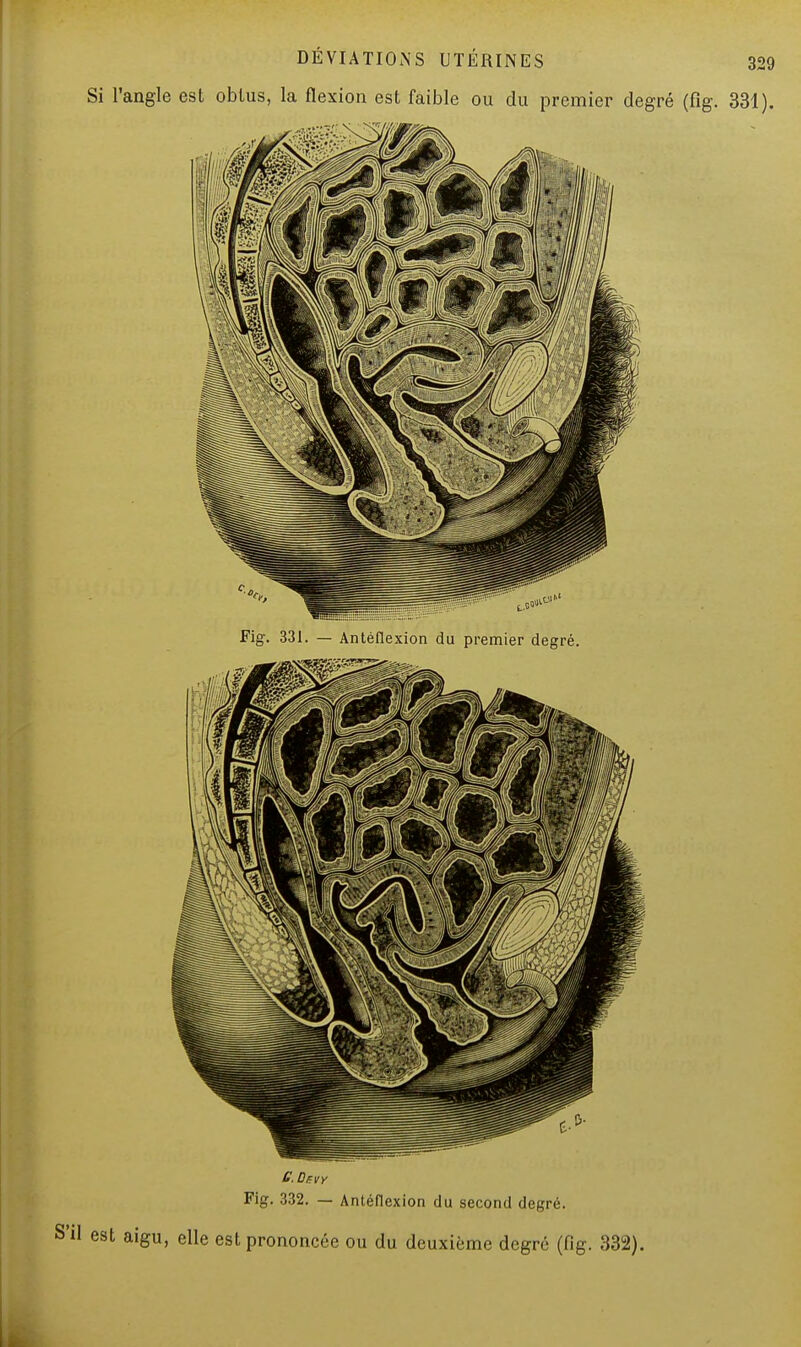 Si l'angle est obtus, la flexion est faible ou du premier degré (fïg. 331). Fig. 331. — Antéflexion du premier degré. C. Dsvy Fig. 332. — Antéflexion du second degré. aigu, elle est prononcée ou du deuxième degré (fig. 332).