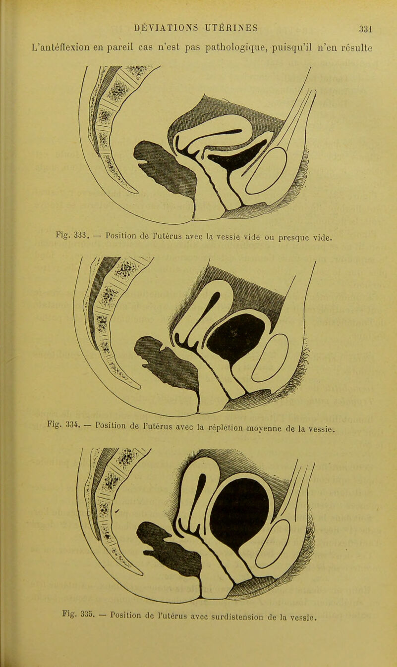 L'antéflexion eu pareil cas n'est pas pathologique, puisqu'il n'en résulte Fig. 335. — Tosition de l'utérus avec surdislension de la vessie.