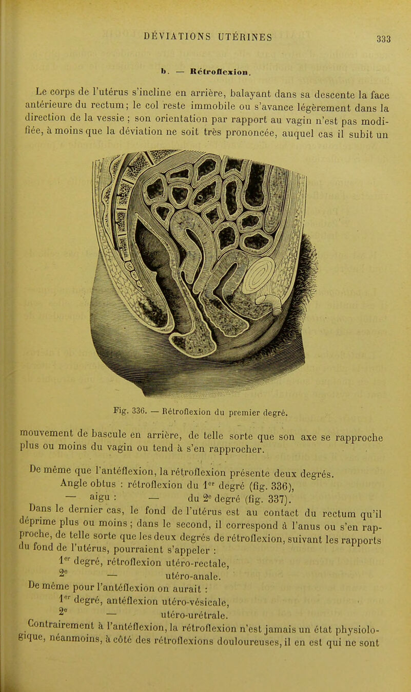 b. — Kélroflcxioii. Le corps de l'utérus s'incline en arrière, balayant dans sa descente la face antérieure du rectum ; le col reste immobile ou s'avance légèrement dans la direction de la vessie ; son orientation par rapport au vagin n'est pas modi- fiée, à moins que la déviation ne soit très prononcée, auquel cas il subit un Fig. 336. — Rétroflexion du premier degré. mouvement de bascule en arrière, de telle sorte que son axe se rapproche plus ou moins du vagin ou tend à s'en rapprocher. De même que l'antéflexion, la rétroflexion présente deux degrés. Angle obtus : rétroflexion du 1er degré (fig. 336), — aigu: — du 2e degré (fig. 337). Dans le dernier cas, le fond de l'utérus est au contact du rectum qu'il déprime plus ou moins ; dans le second, il correspond à l'anus ou s'en rap- proche, de telle sorte que les deux degrés de rétroflexion, suivant les rapports tlu iond de l'utérus, pourraient s'appeler : 1er degré, rétroflexion utéro-rectale, 2e — utéro-anale. De même pour l'antéflexion on aurait : 1er degré, antéflexion utéro-vésicale, ^° — utéro-uré traie. Contrairement h l'antéflexion, la rétroflexion n'est jamais un état physiolo- gie, néanmoins, à côté des rétroflexions douloureuses, il en est qui ne sont