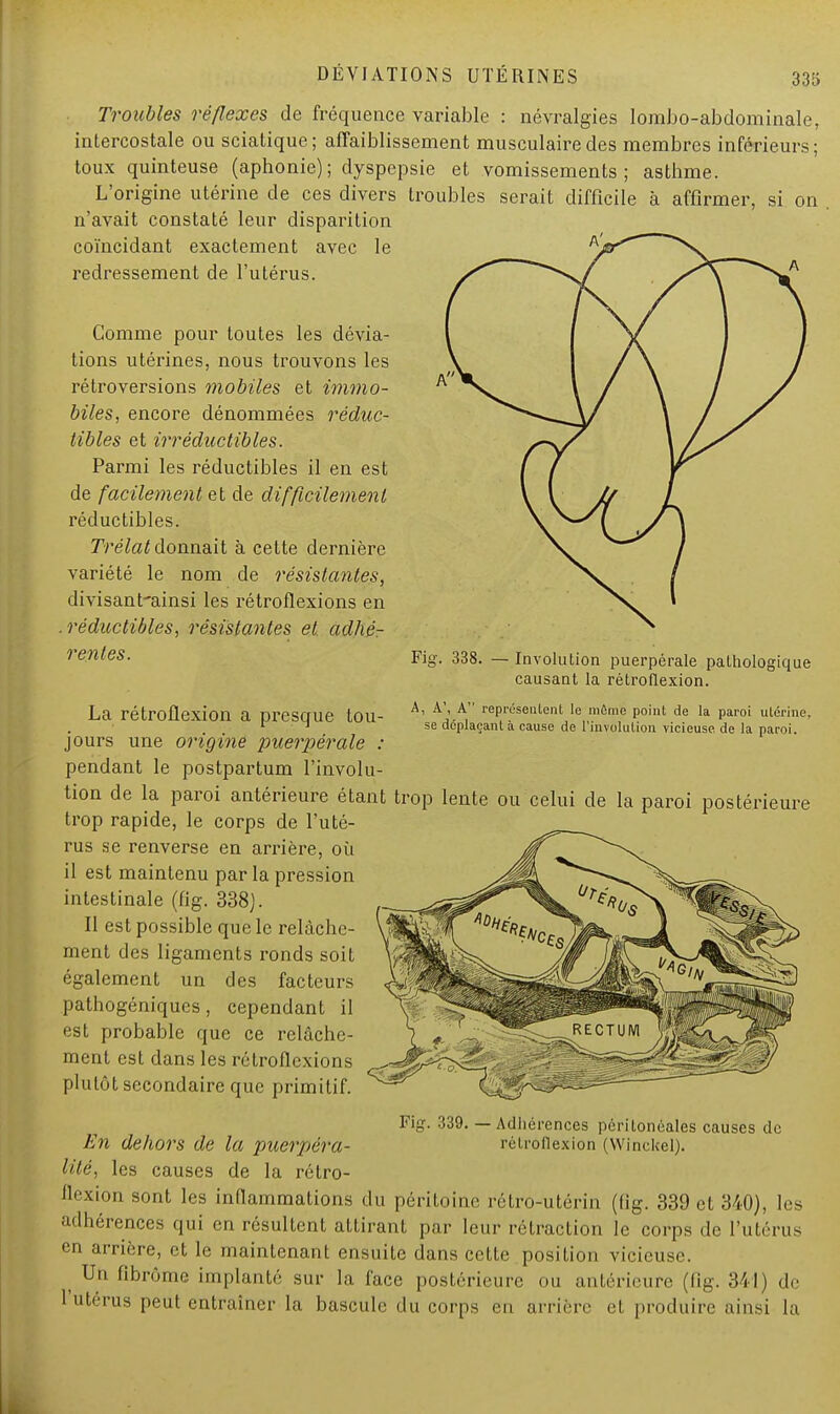 Troubles réflexes de fréquence variable : névralgies lombo-abdominale, intercostale ou sciatique; affaiblissement musculaire des membres inférieurs; toux quinteuse (aphonie); dyspepsie et vomissements; asthme. L'origine utérine de ces divers troubles serait difficile à affirmer, si on n'avait constaté leur disparition coïncidant exactement avec le A- redressement de l'utérus. Comme pour toutes les dévia- tions utérines, nous trouvons les rétroversions mobiles et immo- biles, encore dénommées réduc- tibles et irréductibles. Parmi les réductibles il en est de facilement et de difficilement réductibles. Trélat donnait à cette dernière variété le nom de résistantes, divisant'ainsi les rétroflexions en .réductibles, résistantes et adhé- rentes. Fig. 338. — Involution puerpérale pathologique causant la rétroflexion. A, A', A représentent le même point de la paroi utérine, se déplaçant à cause de l'involution vicieuse de la paroi. La rétroflexion a presque tou jours une origine puerpérale pendant le postpartum l'involu- tion de la paroi antérieure étant trop lente ou celui de la paroi postérieure trop rapide, le corps de l'uté- rus se renverse en arrière, où il est maintenu par la pression intestinale (fig. 338]. Il est possible que le relâche- ment des ligaments ronds soit également un des facteurs pathogéniques, cependant il est probable que ce relâche- ment est dans les rétroflexions plutôt secondaire que primitif. Fig. 339. — Adhérences périlonéales causes de En dehors de la puerpéra- rétroflexion (Winckel). lité, les causes de la rétro- flexion sont les inflammations du péritoine rétro-utérin (fig. 339 et 340), les adhérences qui en résultent attirant par leur rétraction le corps de l'utérus en arrière, et le maintenant ensuite dans cette position vicieuse. , Un ironie implanté sur la face postérieure ou antérieure (fig. 341) de I utérus peut entraîner la bascule du corps en arrière et produire ainsi la