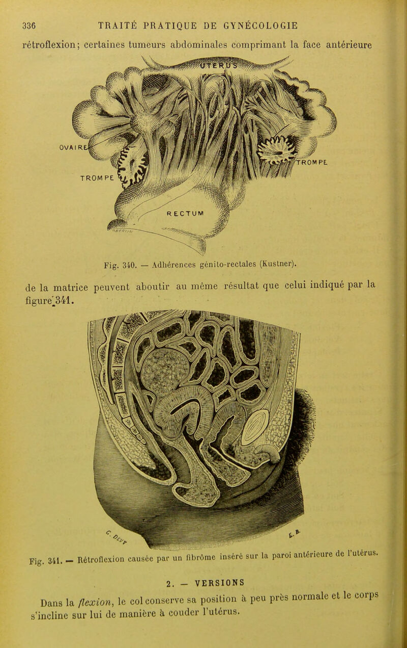 rétroflexion; certaines tumeurs abdominales comprimant la face antérieure Fig. 340. — Adhérences génilo-rectales (Kuslner). de la matrice peuvent aboutir au même résultat que celui indiqué par la figure]341. 2. - VERSIONS Dans la flexion, le col conserve sa position à peu près normale et le corps s'incline sur lui de manière à couder l'utérus.