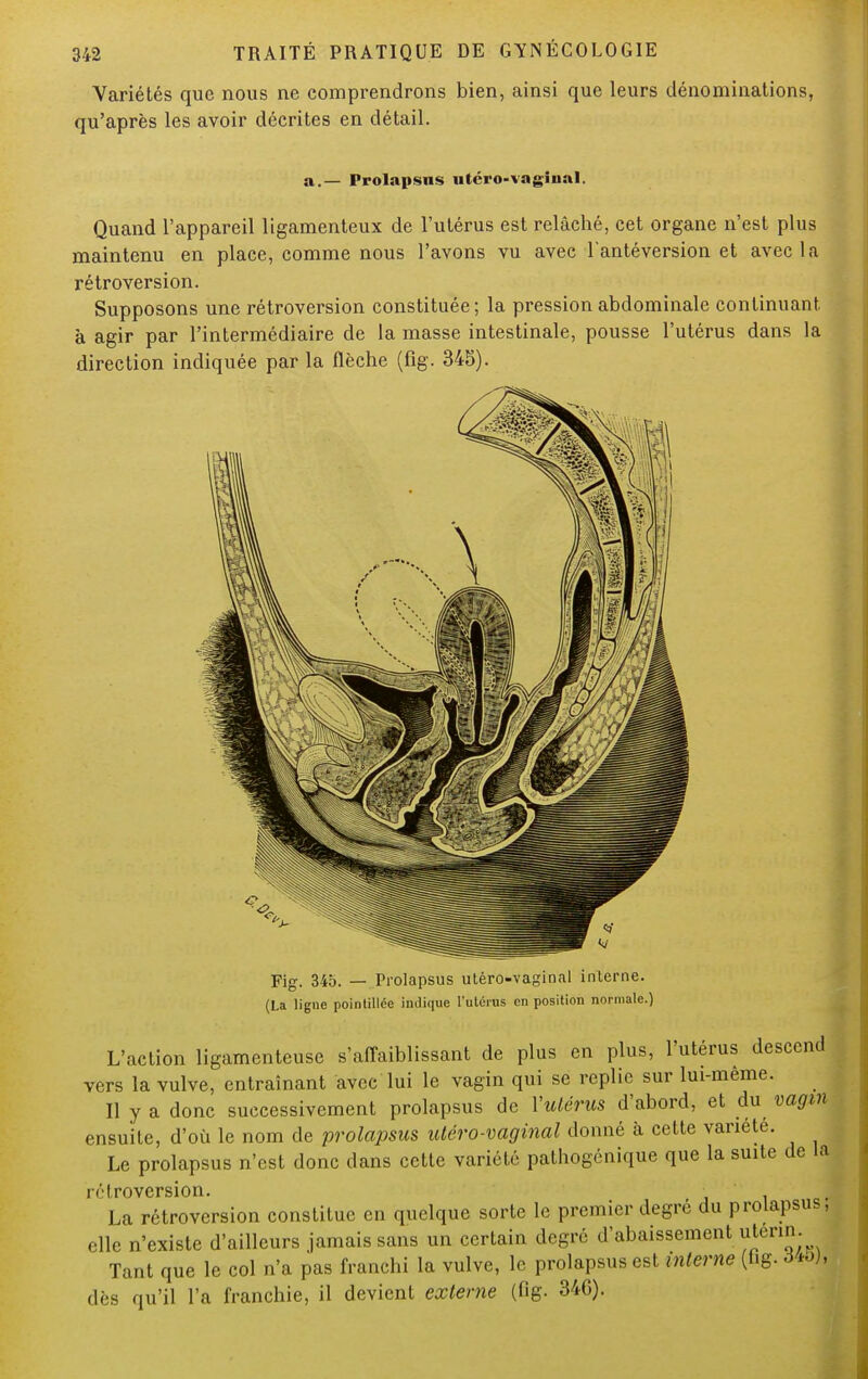 Variétés que nous ne comprendrons bien, ainsi que leurs dénominations, qu'après les avoir décrites en détail. a.— Prolapsns utcro-vagiual. Quand l'appareil ligamenteux de l'utérus est relâché, cet organe n'est plus maintenu en place, comme nous l'avons vu avec l'antéversion et avec la rétroversion. Supposons une rétroversion constituée; la pression abdominale continuant à agir par l'intermédiaire de la masse intestinale, pousse l'utérus dans la direction indiquée par la flèche (fig. 345). Fig. 345. — Prolapsus utéro-vaginnl inlerne. (La ligne pointillce indique l'utérus en position normale.) L'action ligamenteuse s'affaiblissant de plus en plus, l'utérus descend vers la vulve, entraînant avec lui le vagin qui se replie sur lui-même. Il y a donc successivement prolapsus de l'utérus d'abord, et du vagm ensuite, d'où le nom de prolapsus utéro-vaginal donné à cette variété. Le prolapsus n'est donc dans cette variété pathogénique que la suite de la rétroversion. : La rétroversion constitue en quelque sorte le premier degré du prolapsus, elle n'existe d'ailleurs jamais sans un certain degré d'abaissement uterin; Tant que le col n'a pas franchi la vulve, le prolapsus est interne (hg. à&h dès qu'il l'a franchie, il devient externe (fig- 34G).