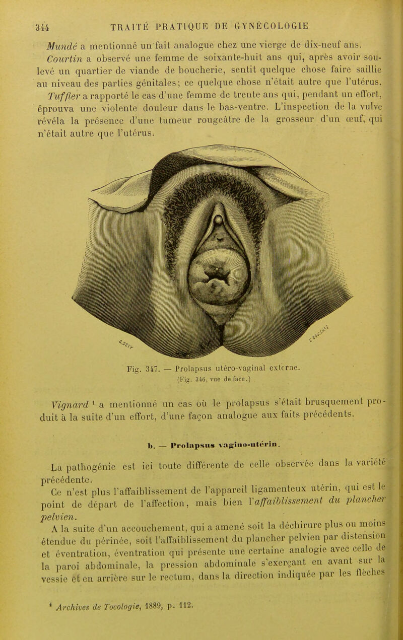 Mandé a mentionné un fait analogue chez une vierge de dix-neuf ans. Courtin a observé une femme de soixante-huit ans qui, après avoir sou- levé un quartier de viande de boucherie, sentit quelque chose faire saillie au niveau des parties génitales; ce quelque chose n'était autre que l'utérus. Tuf fier a rapporté le cas d'une femme de trente ans qui, pendant un effort, éprouva une violente douleur dans le bas-ventre. L'inspection de la vulve révéla la présence d'une tumeur rougeâtre de la grosseur d'un œuf, qui n'était autre que l'utérus. Fig. 347. — Prolapsus utéro-vaginal externe. (Fig. 346, vue de face.) Yignard 1 a mentionné un cas où le prolapsus s'était brusquement pro- duit à la suite d'un effort, d'une façon analogue aux faits précédents. 1). — Prolapsus vagino-utérin. La pathogénie est ici toute différente de celle observée dans la variété précédente. . Ce n'est plus l'affaiblissement de l'appareil ligamenteux utérin, qui csl le point de départ de l'affection, mais bien Vaffaiblissement du plancher A la suite d'un accouchement, qui a amené soil la déchirure plus ou moins étendue du périnée, soil l'affaiblissement du plancher pelvien par distension et éventration, éventration qui présente une certaine analogie avec celle de la paroi abdominale, la pression abdominale s'exerçanl eu avant sur la vessie ri en arrière sur le rectum, dans la direction indiquée par les flèches 4 Archives de Tucologie, 1889, p. 112.