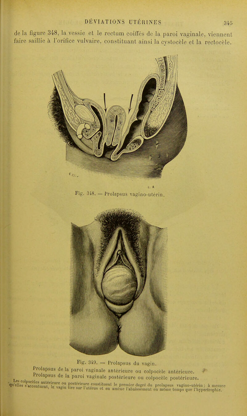 Fig. 348. — Prolapsus vagino-utérin. Fig. 340. — Prolapsus du vagin. Prolapsus delà paroi vaginale antérieure ou colpocèle antérieure, irolapsus de la paroi vaginale postérieure ou colpocèle postérieure. Velle?fetèntu?n\é1tflLb ttr?£i*ï?ÎT' f« ^«»* «tagrf da prolapsus vagino-utérin; à mesure <■ui.ni, ie vagin tire sur 1 utérus et on amène l'abaissement en même temps que l'hypertrophie.