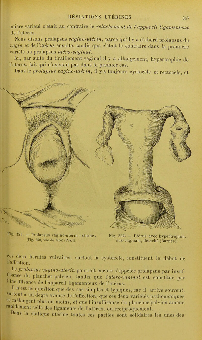 miôre variété c'était au contraire le relâchement de l'appareil ligamenteux de l'utérus. Nous disons prolapsus vagino-utérin, parce qu'il y a d'abord prolapsus du vagin et de Y utérus ensuite, tandis que c'était le contraire dans la première variété ou prolapsus utéro-vaginal. Ici, par suite du tiraillement vaginal il y a allongement, hypertrophie de l'utérus, fait qui n'existait pas dans le premier cas. Dans le prolapsus vagino-utérin, il y a toujours cystocèle et rectocèle, et ig. 351. — Prolapsus vagino-utérin externe. Fig. 352. — Utérus avec hypertrophie. (Fig. 350, vue de face) (Pozzi). sus-vaginale, détaché (Barnes). ces deux hernies vulvaires, surtout la cystocèle, constituent le début de 1 affection. Le prolapsus vagino-utérin pourrait encore s'appeler prolapsus par insuf- fisance du plancher pelvien, tandis que Yulèro-vaginal est constitué par insuffisance de l'appareil ligamenteux de l'utérus. Il n'est ici queslion que des cas simples et typiques, car il arrive souvent, Surtout à un degré avancé de l'affection, que ces deux variétés pathogéniques se mélangent plus ou moins, et que l'insuffisance du plancher pelvien amène rapidement celle des ligaments de l'utérus, ou réciproquement. -'ans la statique utérine toutes ces parties sont solidaires les unes des