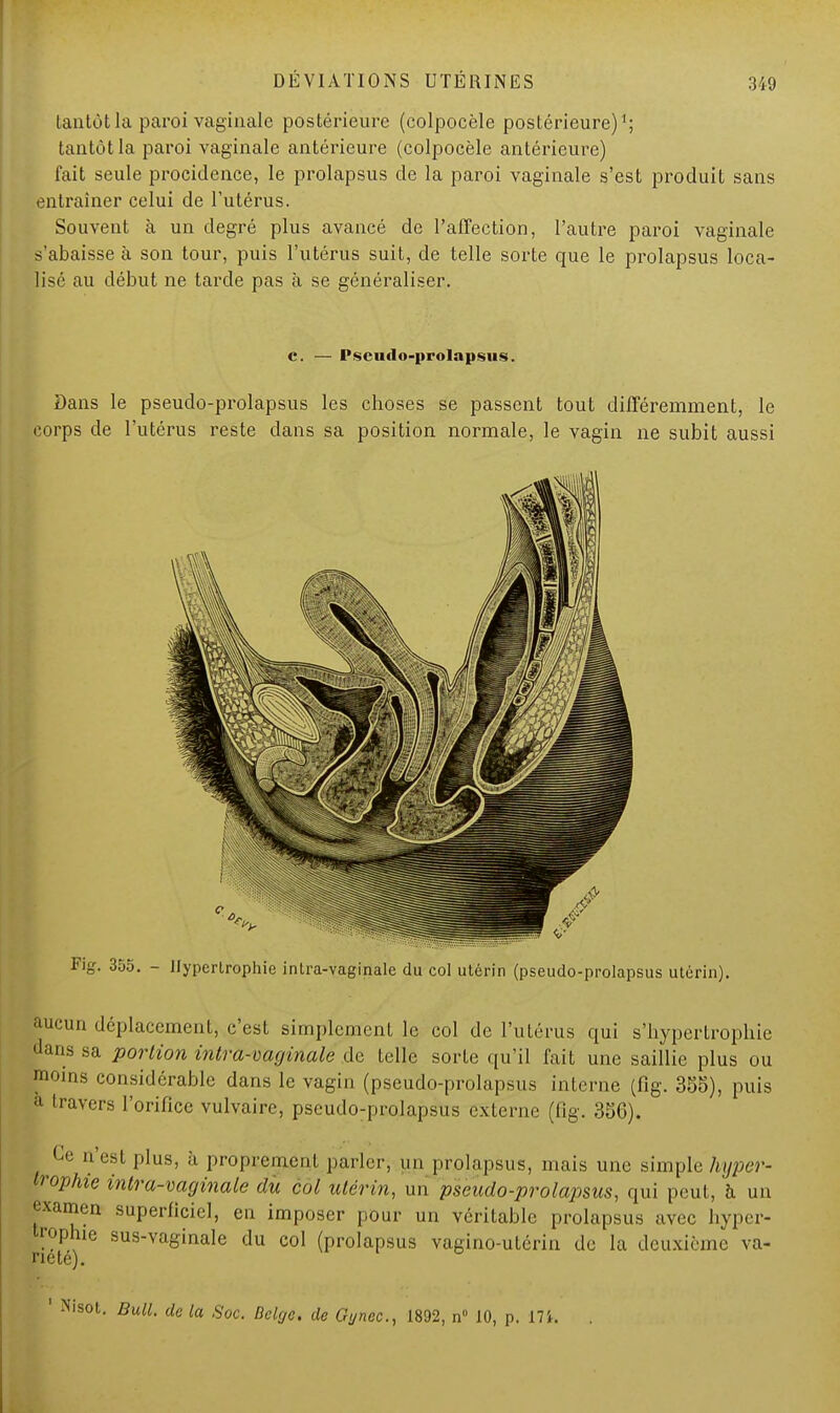 tantôt la paroi vaginale postérieure (colpocèle postérieure)1; tantôt la paroi vaginale antérieure (colpocèle antérieure) fait seule procidence, le prolapsus de la paroi vaginale s'est produit sans entraîner celui de l'utérus. Souvent à un degré plus avancé de l'affection, l'autre paroi vaginale s'abaisse à son tour, puis l'utérus suit, de telle sorte que le prolapsus loca- lisé au début ne tarde pas à se généraliser. c. — Pseudo-prolapsus. Dans le pseudo-prolapsus les choses se passent tout différemment, le corps de l'utérus reste dans sa position normale, le vagin ne subit aussi Fig. 355. - Hypertrophie inlra-vaginale du col utérin (pseudo-prolapsus utérin). aucun déplacement, c'est simplement le col de l'utérus qui s'hyperlrophie dans sa portion intra-varjinale de telle sorte qu'il fait une saillie plus ou ,n,iis considérable dans le vagin (pseudo-prolapsus interne (fig. 385), puis ;| travers l'orifice vulvaire, pseudo-prolapsus externe (fig. 356). Ce n'est plus, à proprement parler, un prolapsus, mais une simple hyper- trophie intra-vaginale du col utérin, un pseudo-prolapsus, qui peut, à un examen superficiel, eu imposer pour un véritable prolapsus avec hyper- trophie sus-vaginale du col (prolapsus vagino-utérin de la deuxième va- riété). 1 Nisot. Bull, de la Soc. Belge, de Gynec, 1892, n° 10, p. m. .