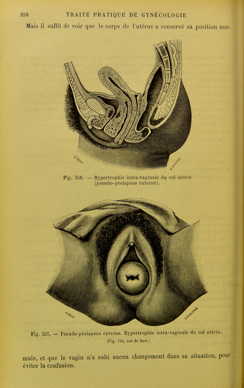 Mais il suffit de voir que le corps de l'utérus a conservé sa position nor- Fig. 356. — Hypertrophie intra-vaginale du col utérin (pseudo-prolapsus externe). maie, et que le vagin n'a subi aucun changement dans sa situation, pour éviter la confusion.