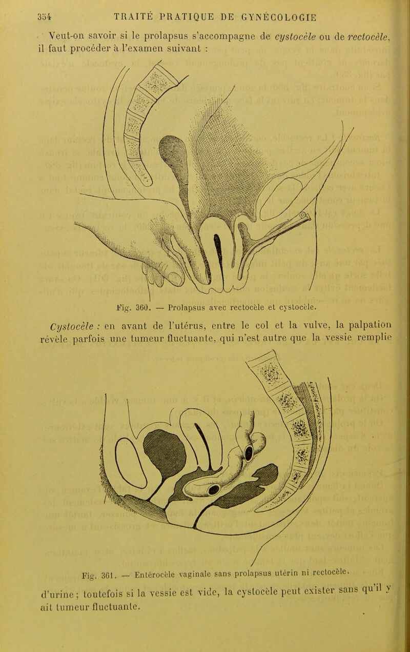 Veul-on savoir si le prolapsus s'accompagne de cyslocèle ou de rectocèle, il faut procéder à l'examen suivant : Fig. 360. — Prolapsus avec rectocèle et cystocèle. Cyslocèle : en avant cle l'utérus, entre le col et la vulve, la palpation révèle parfois une tumeur fluctuante, qui n'est autre que la vessie remplie à Fi. 301. — Entérocèle vaginale sans prolapsus utérin ni rectocèle. d'urine; toutefois si la vessie est vicie, la cyslocèle peut exister sans qu'il y ait tumeur fluctuante.