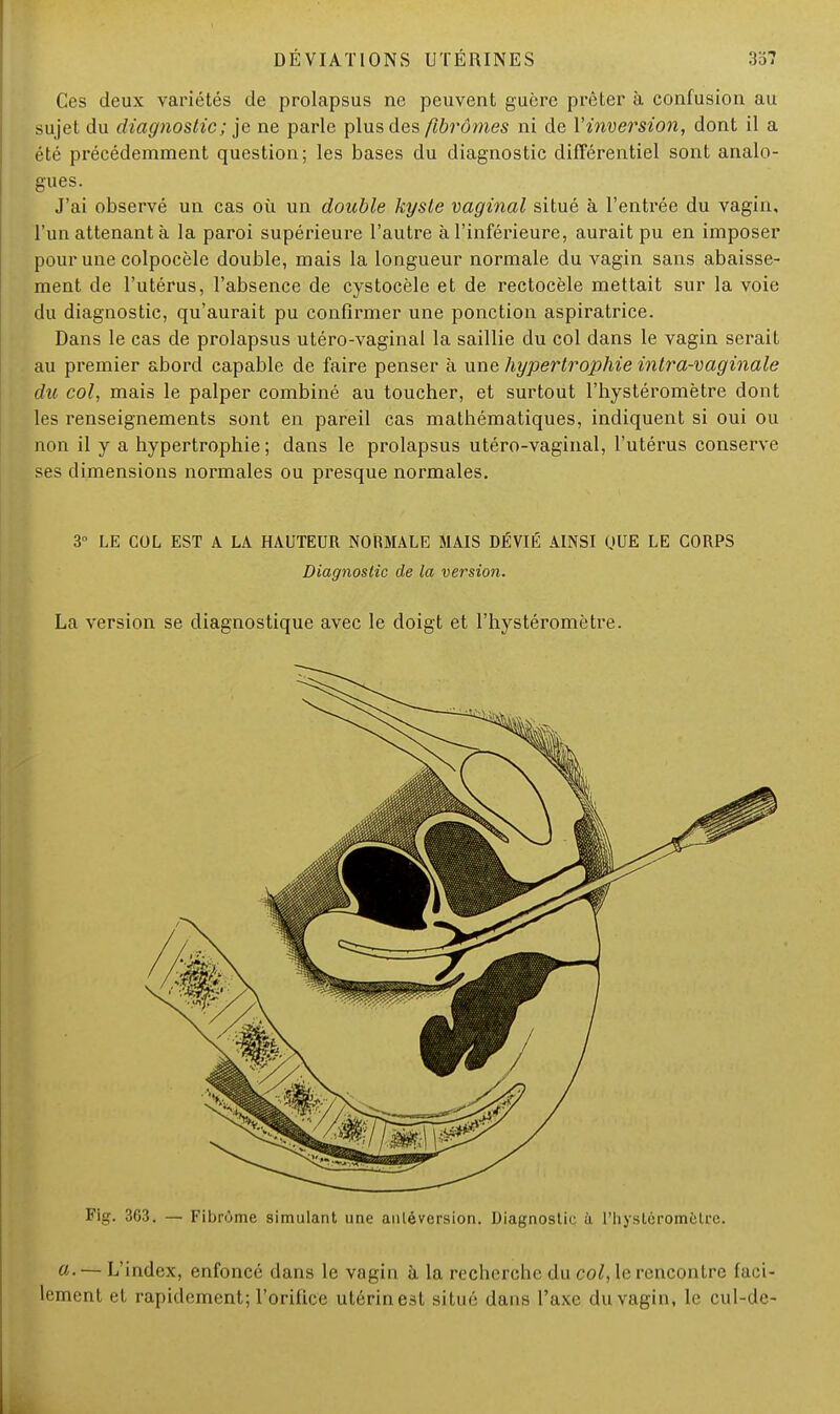 Ces deux variétés de prolapsus ne peuvent guère prêter à confusion au sujet du diagnostic ; je ne parle plus des fibromes ni de l'inversion, dont il a été précédemment question; les bases du diagnostic différentiel sont analo- gues. J'ai observé un cas où un double kyste vaginal situé à l'entrée du vagin, l'un attenant à la paroi supérieure l'autre à l'inférieure, aurait pu en imposer pour une colpocèle double, mais la longueur normale du vagin sans abaisse- ment de l'utérus, l'absence de cystocèle et de rectocèle mettait sur la voie du diagnostic, qu'aurait pu confirmer une ponction aspiratrice. Dans le cas de prolapsus utéro-vaginal la saillie du col dans le vagin serait au premier abord capable de faire penser à une hypertrophie intra-vaginale du col, mais le palper combiné au toucher, et surtout l'hystéromètre dont les renseignements sont en pareil cas mathématiques, indiquent si oui ou non il y a hypertrophie ; dans le prolapsus utéro-vaginal, l'utérus conserve ses dimensions normales ou presque normales. 3° LE COL EST A LA HAUTEUR NORMALE MAIS DÉVIÉ AINSI QUE LE CORPS Diagnostic de la version. La version se diagnostique avec le doigt et l'hystéromètre. Fig. 363. — Fibrome simulant une anléversion. Diagnostir à l'hysléromètce. a. — L'index, enfoncé dans le vagin à la recherche du col, le rencontre faci- lement et rapidement; l'orifice utérin est situé dans l'axe du vagin, le cul-dé-