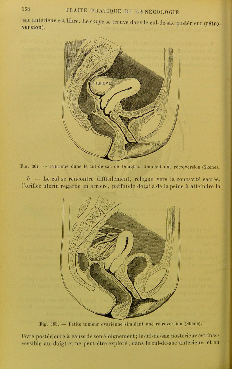 Fig. 364 -- Fibrôme dans le cul-de-sac de Douglas, simulant une rétroversion (Skene). b. — Le col se rencontre difficilement, relégué vers la concavité sacrée, l'orifice utérin regarde en arrière, parfois le doigt a de la peine à atteindre la Fig. 365. — Fctite tumeur ovarienne simulant une rétroversion (Skene). lèvre postérieure à cause de son éloignement; le cul-de-sac postérieur est inac- cessible au doigt et ne peut être exploré; dans le cul-de-sac antérieur, et en