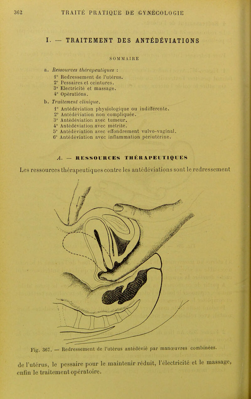 I. — TRAITEMENT DES ANTÉDÉVIATIONS SOMMAIRE a. Ressources thérapeutiques : 1° Redressement de l'utérus. 2° Pessaires et ceintures. 3° Electricité et massage. 4° Opérations. b. Traitement clinique. 1° Antédévialion physiologique ou indifférente. 2° Antédévialion non compliquée. 3° Antédévialion avec tumeur. 4° Antédéviation avec métrite. 5° Antédéviation avec effondrement vulvo-vaginal. 6° Antédéviation avec inflammation périutérine. Fig. 367. — Redressement de l'utérus antédévié par manœuvres combinées. de l'utérus, le pessaire pour le maintenir réduit, l'électricité et le massage, enfin le traitement opératoire.