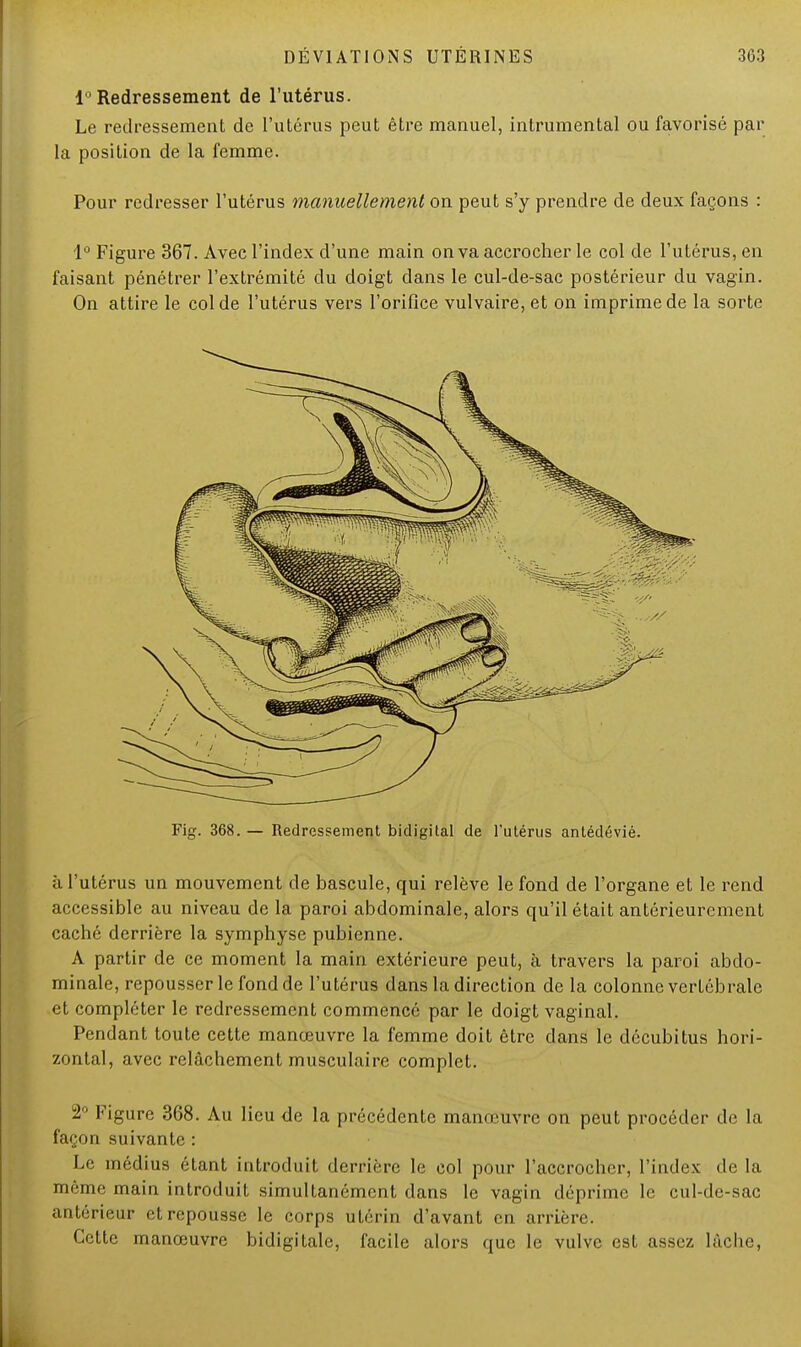 1° Redressement de l'utérus. Le redressement de l'utérus peut être manuel, intrumental ou favorisé par la position de la femme. Pour redresser l'utérus manuellement on peut s'y prendre de deux façons : 1° Figure 367. Avec l'index d'une main on va accrocher le col de l'utérus, en faisant pénétrer l'extrémité du doigt dans le cul-de-sac postérieur du vagin. On attire le col de l'utérus vers l'orifice vulvaire, et on imprime de la sorte Fig. 368. — Redressement bidigital de l'utérus antédévié. à l'utérus un mouvement de bascule, qui relève le fond de l'organe et le rend accessible au niveau de la paroi abdominale, alors qu'il était antérieurement caché derrière la symphyse pubienne. A partir de ce moment la main extérieure peut, à travers la paroi abdo- minale, repousser le fond de l'utérus dans la direction de la colonne vertébrale et compléter le redressement commencé par le doigt vaginal. Pendant toute cette manœuvre la femme doit être dans le décubitus hori- zontal, avec relâchement musculaire complet. 2° Figure 368. Au lieu de la précédente manœuvre on peut procéder de la façon suivante : Le médius étant introduit derrière le col pour l'accrocher, l'index de la même main introduit simultanément dans le vagin déprime le cul-de-sac antérieur et repousse le corps utérin d'avant en arrière. Cette manœuvre bidigitale, facile alors que le vulve est assez lâche,