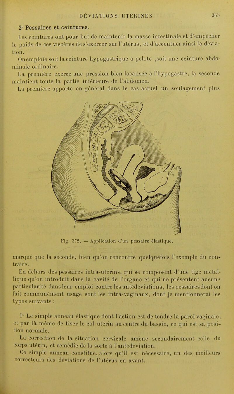 2° Pessaires et ceintures. Les ceintures ont pour but de maintenir la masse intestinale et d'empêcher le poids de ces viscères de s'exercer sur l'utérus, et d'accentuer ainsi la dévia- Lion. Onemploie soit la ceinture hypogastrique à pelote ,soit une ceinture abdo- minale ordinaire. La première exerce une pression bien localisée à l'hypogastre, la seconde maintient toute la partie inférieure de l'abdomen. La première apporte en général dans le cas actuel un soulagement plus Fig. 372. — Application d'un pessaire élastique. marqué que la seconde, bien qu'on rencontre quelquefois l'exemple du con- traire. En dehors des pessaires intra-utérins, qui se composent d'une tige métal- lique qu'on introduit dans la cavité de l'organe et qui ne présentent aucune particularité dans leur emploi contre les antédéviations, les pessaires dont on fait communément usage sont les intra-vaginaux, dont je mentionnerai les types suivants : L° Le simple anneau élastique dont l'action est de tendre la paroi vaginale, et par là même de lixcr le col utérin au centre du bassin, ce qui est sa posi- I ion normale. La correction de la situation cervicale amène secondairement celle du corps utérin, et remédie de la sorte à l'antédéviation. Ce simple anneau constitue, alors qu'il est nécessaire, un des meilleurs correcteurs des déviations de l'utérus en avant.