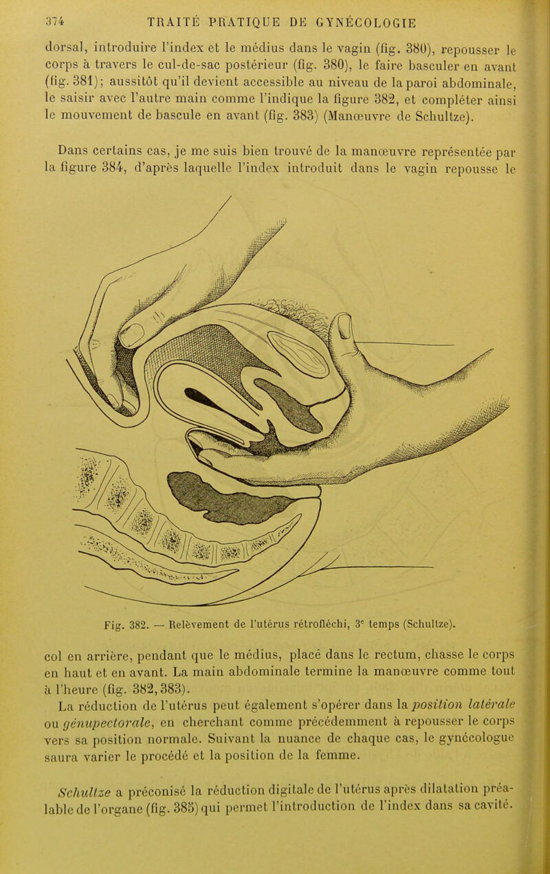 dorsal, introduire l'index et le médius dans le vagin (fig. 380), repousser le corps à travers le cul-de-sac postérieur (fig. 380), le faire basculer en avant (fig. 381); aussitôt qu'il devient accessible au niveau de la paroi abdominale, le saisir avec l'autre main comme l'indique la figure 382, et compléter ainsi le mouvement de bascule en avant (fig. 383) (Manœuvre de Schultze). Dans certains cas, je me suis bien trouvé de la manœuvre représentée par la figure 384, d'après laquelle l'index introduit dans le vagin repousse le Fig. 382. — Relèvement de l'utérus rétrofléchi, 3e temps (Schultze). col en arrière, pendant que le médius, placé dans le rectum, chasse le corps en haut et en avant. La main abdominale termine la manœuvre comme tout a l'heure (fig. 382,383). La réduction de l'utérus peut également s'opérer dans la position latérale ou génupeclorale, en cherchant comme précédemment à repousser le corps vers sa position normale. Suivant la nuance de chaque cas, le gynécologue saura varier le procédé et la position de la femme. Schultze a préconisé la réduction digitale de l'utérus après dilatation préa- lable de l'organe (fig. 385) qui permet l'introduction de l'index dans sa cavité.