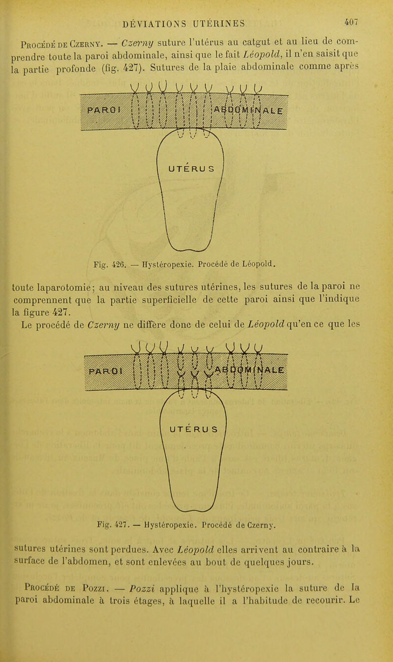 Procédé de Czerny. — Czerny suture l'utérus au catgut et au lieu de com- prendre toute la paroi abdominale, ainsi que le fait Léopold, il n'en saisit que la partie profonde (fig. 427). Sutures de la plaie abdominale comme après PARO I ■ )A^DO'm IjN AL E '.' \i ',/ \I \J. \ ;J f-..\! ' Fig. 426. — Hystéropexie. Procédé de Léopold. toute laparotomie; au niveau des sutures utérines, les sutures de la paroi ne comprennent que la partie superficielle de cette paroi ainsi que l'indique la figure 427. Le procédé de Czerny ne diffère donc de celui de Léopold qu'en ce que les 'v::';v, .:,..^r- Fig. 427. — Hystéropexie. Procédé de Czerny. sutures utérines sont perdues. Avec Léopold elles arrivent au contraire à la surface de l'abdomen, et sont enlevées au bout de quelques jours. Procédé de Pozzi. — Pozzi applique à ^hystéropexie la suture de la paroi abdominale à trois étages, à laquelle il a l'habitude de recourir. Le