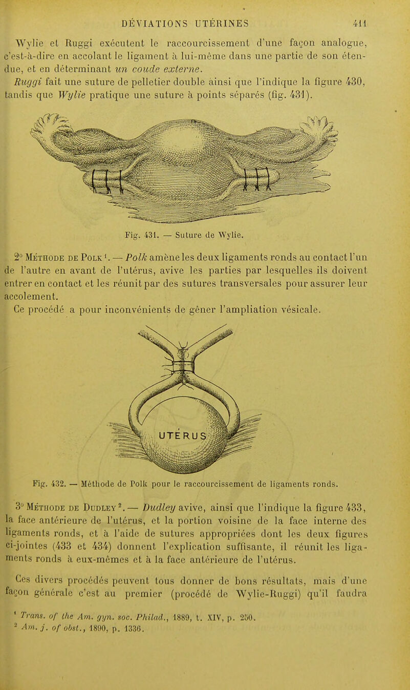 Wylie et Ruggi exécutent le raccourcissement d'une façon analogue, c'est-à-dire en accolant le ligament à lui-même dans une partie de son éten- due, et en déterminant un coude externe. Ruggi fait une suture de pelletier double ainsi que l'indique la figure 430, tandis que Wylie pratique une suture à points séparés (fig. 431). Fig. 431. — Suture de Wylie. 2° Méthode de Polk 1. — Polk amène les deux ligaments ronds au contact l'un de l'autre en avant de l'utérus, avive les parties par lesquelles ils doivent entrer en contact et les réunit par des sutures transversales pour assurer leur accolement. Ce procédé a pour inconvénients de gêner l'ampliation vésicale. Fig. 432. — Méthode de Polk pour le raccourcissement de ligaments ronds. 3° Méthode de Dudley2.— Dudley avive, ainsi que l'indique la figure 433, la face antérieure de l'utérus, et la portion voisine de la face interne des ligaments ronds, et à l'aide de sutures appropriées dont les deux figures ci-jointes (433 et 434) donnent l'explication suffisante, il réunit les liga- ments ronds à eux-mêmes et à la face antérieure de l'utérus. Ces divers procédés peuvent tous donner de bons résultats, mais d'une façon générale c'est au premier (procédé de Wylie-Ruggi) qu'il faudra Tram, of ihe Am. gyn. soc. Philad., 1889, t. XIV, p. 250. - Am. j. of obst., 1890, p. 1336.