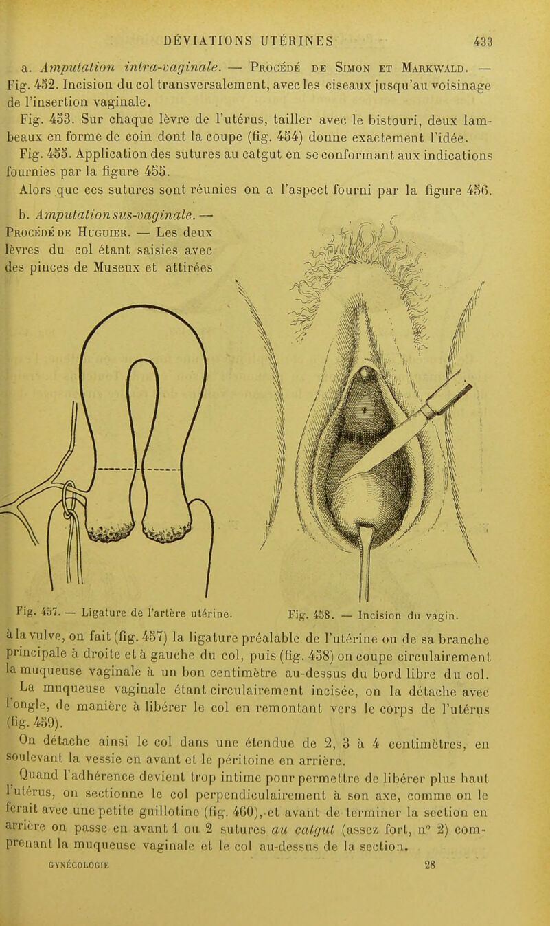 a. Amputation intra-vaginale. — Procédé de Simon et Markwald. — Fig. 452. Incision du col transversalement, avec les ciseaux jusqu'au voisinage de l'insertion vaginale. Fig. 453. Sur chaque lèvre de l'utérus, tailler avec le bistouri, deux lam- beaux en forme de coin dont la coupe (fig. 454) donne exactement l'idée. Fig. 455. Application des sutures au catgut en se conformant aux indications fournies par la figure 455. Alors que ces sutures sont réunies on a l'aspect fourni par la figure 456. / 1 Fig. i57. — Ligature de l'artère utérine. Fig. 458. — Incision du vagin. à la vulve, on fait (fig. 457) la ligature préalable de l'utérine ou de sa branche principale à droite et à gauche du col, puis (fig. 458) on coupe circulairement la muqueuse vaginale à un bon centimètre au-dessus du bord libre du col. La muqueuse vaginale étant circulairement incisée, on la détache avec l'ongle, de manière à libérer le col en remontant vers le corps de l'utérus (fig. 459). On détache ainsi le col dans une étendue de 2, 3 à 4 centimètres, en soulevant la vessie en avant et le péritoine en arrière. Quand l'adhérence devient trop intime pour permettre de libérer plus haut Lutérus, on sectionne le col perpendiculairement à son axe, comme on le ferait avec une petite guillotine, (fig. 460), et avant de terminer la section en arrière on passe en avant 1 ou 2 sutures au catgul (assez fort, n° 2) com- prenant la muqueuse vaginale et le col au-dessus de la section. GYNÉCOLOGIE 28