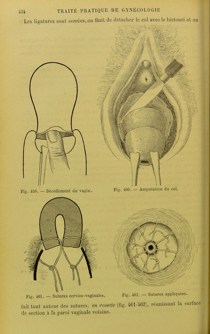 Les ligatures sont serrées, on finit de détacher le col avec le bistouri et on fait tout autour des sutures, en rosette (flg. 461-462), réunissant de section à Ta paroi vaginale voisine.