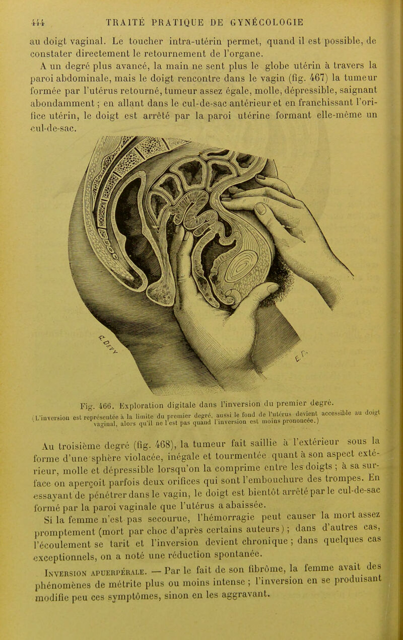 au doigt vaginal. Le toucher intra-utérin permet, quand il est possible, de constater directement le retournement de l'organe. A un degré plus avancé, la main ne sent plus le globe utérin à travers la paroi abdominale, mais le doigt rencontre dans le vagin (fig. 467) la tumeur formée par l'utérus retourné, tumeur assez égale, molle, dépressible, saignant abondamment ; en allant dans le cul-de-sac antérieur et en franchissant l'ori- fice utérin, le doigt est arrêté par la paroi utérine formant elle-même un ■cul-de-sac. Fig. 466. Exploration digitale dans l'inversion du premier degré. L'inversion est représentée à la limite du premier degré, aussi le fond de l'utérus devient accessible au doigt vaginal, alors qu'il ne l'est pas quand 1 inversion est moins prononcée.) Au troisième degré (fig. 468), la tumeur fait saillie à l'extérieur sous la forme d'une sphère violacée, inégale et tourmentée quant à son aspect exté- rieur, molle et dépressible lorsqu'on la comprime entre les doigts ; à sa sur- face on aperçoit parfois deux orifices qui sont l'embouchure des trompes. En essayant de pénétrer dans le vagin, le doigt est bientôt arrêté par le cul-de-sac formé par la paroi vaginale que l'utérus a abaissée. Si la femme n'est pas secourue, l'hémorragie peut causer la mort assez promptement (mort par choc d'après certains auteurs); dans d'autres cas, l'écoulement se tarit et l'inversion devient chronique ; dans quelques cas exceptionnels, on a noté une réduction spontanée. Inversion apuerpéRALE. - Par le fait de son fibrome, la femme avait des phénomènes de métrite plus ou moins intense ; l'inversion en se produisant modifie peu ces symptômes, sinon en les aggravant.