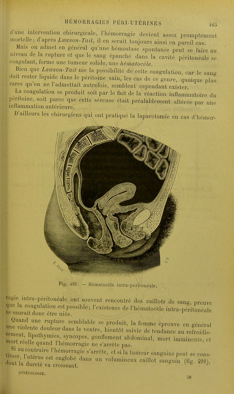 d'une intervention chirurgicale, l'hémorragie devient assez promptement mortelle; daprès Laivson-Tait, il en serait toujours ainsi en pareil cas. Mais on admet en général qu'une hémostase spontanée peut se faire au niveau de la rupture et que le sang épanché dans la cavité péritonéalc se coagulant, forme une tumeur solide, une hémalocèle. Bien que Laioson-Tait nie la possibilité de cette coagulation, car le sang doit rester liquide dans le péritoine sain, les cas de ce genre, quoique plus rares qu'on ne l'admettait autrefois, semblent cependant exister La coagulation se produit soit par le fait de la réaction inflammatoire du péritoine, soit parce que cette séreuse était préalablement altérée par une inflammation antérieure. D'ailleurs les chirurgiens qui ont pratiqué la laparotomie en cas d'hémor- Fig. 491. — Hémalocèle intra-périlonéale. ragie intra-périlonéale ont souvent rencontré des caillots de sang preuve que la coagulation est possible; l'existence de l'hématocèle intra-péritonéalc ne saurait donc être niée. Quand une rupture semblable se produit, la femme éprouve en général ; . « violente douleur dans le ventre, bientôt suivie de tendance au refroTdiï- morTrï ÎP yTr,' S0nflemcnt abdominal, mort imminente, et mort réelle quand l'hémorragie ne s'arrête pas. S. au cojitrairc l'hémorragie s'arrête, et si 1, tumeur sanguine peut se cens- don M» ? TS enS °b6 danS lM1 volumin™* caillot sanguin (fig. 491), «ont la dureté va croissant. Vo ;' GYNÉCOLOGIE. 30