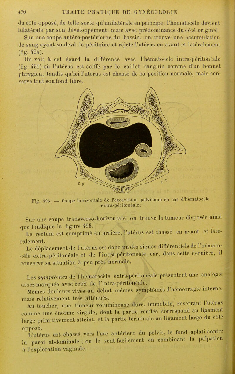 du côté opposé, de telle sorte qu'unilatérale en principe, l'hématocèle devient bilatérale par son développement, mais avec prédominance du côté originel. Sur une coupe antéro-postérieure du bassin, on trouve une accumulation de sang ayant soulevé le péritoine et rejeté l'utérus en avant et latéralement (fig. 494). On voit à cet égard la différence avec l'hématocèle intra-péritonéale (tig. 491) où l'utérus est coiffé par le caillot sanguin comme d'un bonnet phrygien, tandis qu'ici l'utérus est chassé de sa position normale, mais con- serve tout son fond libre. Fi. 495. — Coupe horizontale de l'excavation pelvienne en cas d'hématocèle extra-péritonèale. Sur une coupe transverso-horizontale, on trouve la tumeur disposée ainsi que l'indique la figure 495. Le rectum est comprimé en arrière, l'utérus est chassé en avant et laté- ralement. Le déplacement de l'utérus est donc un des signes différentiels de 1 hemato- cèle extra-péritonéale et de l'intra-péritonéale, car, dans cette dernière, il conserve sa situation à peu près normale. Les symptômes de l'hématocèle extra-péritonéale présentent une analogie assez marquée avec ceux de l'intra-péritonéale. Mêmes douleurs vives au début, mêmes symptômes d'hémorragie interne, mais relativement très atténués. Au toucher, une tumeur volumineuse dure, immobile, enserrant l'utérus comme une énorme virgule, dont la partie renflée correspond au ligament large primitivement atteint, et la partie terminale au ligament large du cote ^Vutérus est chassé vers l'arc antérieur du pelvis, le fond aplati contre la paroi abdominale ; on le sent facilement en combinant la palpation à l'exploration vaginale.