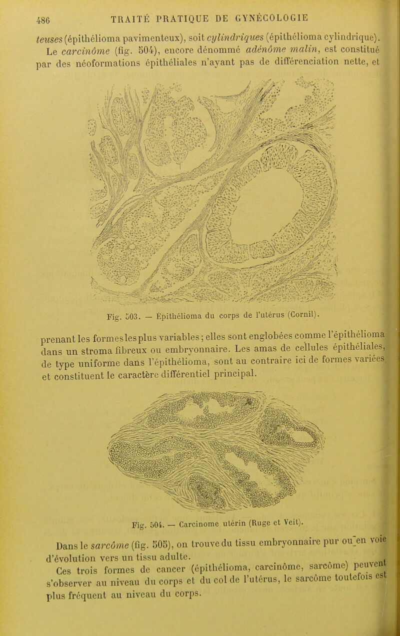 teitses (épithélioma pavimenteux), soit cylindriques (épithélioma cylindrique). Le carcinôme (fig. 504), encore dénommé adénome malin, est constitué par des néoformations épithéliales n'ayant pas de différenciation nette, et Fig. 503. — Épithélioma du corps de l'utérus (Gornil). prenant les formeslesplus variables ; elles sont englobées comme l'épithélioma dans un stroma fibreux ou embryonnaire. Les amas de cellules épithéliales, de type uniforme dans l'épithélioma, sont au contraire ici de formes variées et constituent le caractère différentiel principal. Fig. 504. — Carcinome utérin (Ruge et Veit). Dans le sarcome (fig. 505), on trouve du tissu embryonnaire pur ou> voie d'évolution vers un tissu adulte. Ces trois formes de cancer (épithélioma, carcinôme, sarcome) peuvent s'observer au niveau du corps et du col de l'utérus, le sarcome toutefois est plus fréquent au niveau du corps.