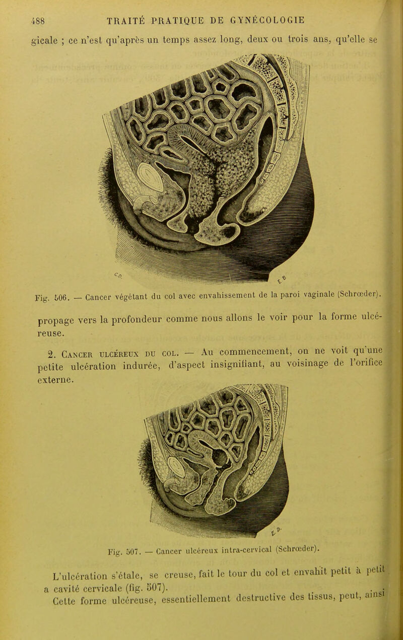 gicale ; ce n'est qu'après un temps assez long, deux ou trois ans, qu'elle se Fig. £.06. — Cancer végétant du col avec envahissement de la paroi vaginale (Schrœder). propage vers la profondeur comme nous allons le voir pour la forme ulcé- reuse. 2. Cancer ulcéreux du col. — Au commencement, on ne voit qu'une petite ulcération indurée, d'aspect insignifiant, au voisinage de l'orifice externe. Fig. 507. — Cancer ulcéreux intra-ccrvical (Schrœder). L'ulcération s'étale, se creuse, fait le tour du col et envahit petit à petfl a cavité cervicale (fig. 507). _ 1 Cette forme ulcéreuse, essentiellement destructive des tissus, peut, ainsi