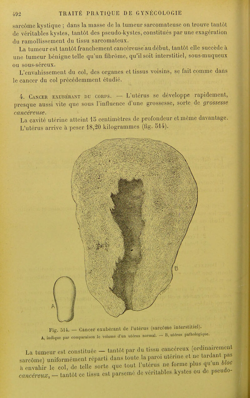 sarcome kystique ; dans la masse de la tumeur sarcomateuse on trouve tantôt de véritables kystes, tantôt des pseudo-kystes, constitués par une exagération du ramollissement du tissu sarcomateux. La tumeur est tantôt franchement cancéreuse'au début, tantôt elle succède à une tumeur bénigne telle qu'un fibrome, qu'il soit interstitiel, sous-muqueux ou sous-séreux. L'envahissement du col, des organes et tissus voisins, se fait comme dans le cancer du col précédemment étudié. 4. Cancer exubérant du corps. — L'utérus se développe rapidement, presque aussi vite que sous l'influence d'une grossesse, sorte de grossesse cancéreuse. La cavité utérine atteint 15 centimètres de profondeur et même davantage. L'utérus arrive à peser 18,20 kilogrammes (fig. 514). ' wm. Fig. 514. - Cancer exubérant de l'utérus (sarcôme interstitiel). A, indique pur comparaison le volume d'Un utéruB normal. - B, utérus pathologique. La tumeur est constituée - tantôt par du tissu cancéreux M*^* sarcôme) uniformément réparti dans toute la paroi utérine et ne tardant pas à envahir le col, de telle sorte que tout l'utérus ne forme cancéreux, - tantôt ce tissu est parsemé de véritables kystes ou de pseudo