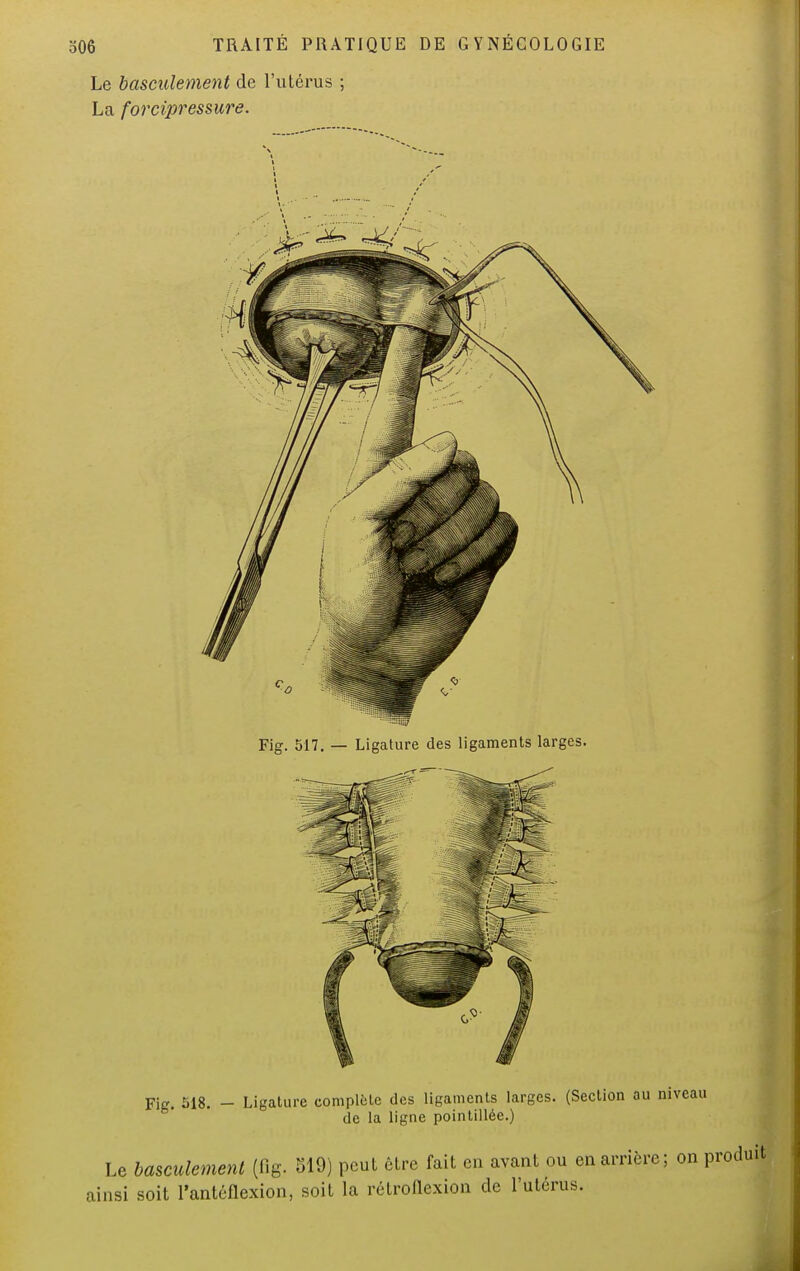 Fig. 518. - Ligature complète des ligaments larges. (Section ou niveau de la ligne pointillée.) Le basculement (flg. 519) peut être fait en avant ou en arrière; on produit ainsi soit l'antéflexion, soit la rétroflexion de Puterus.