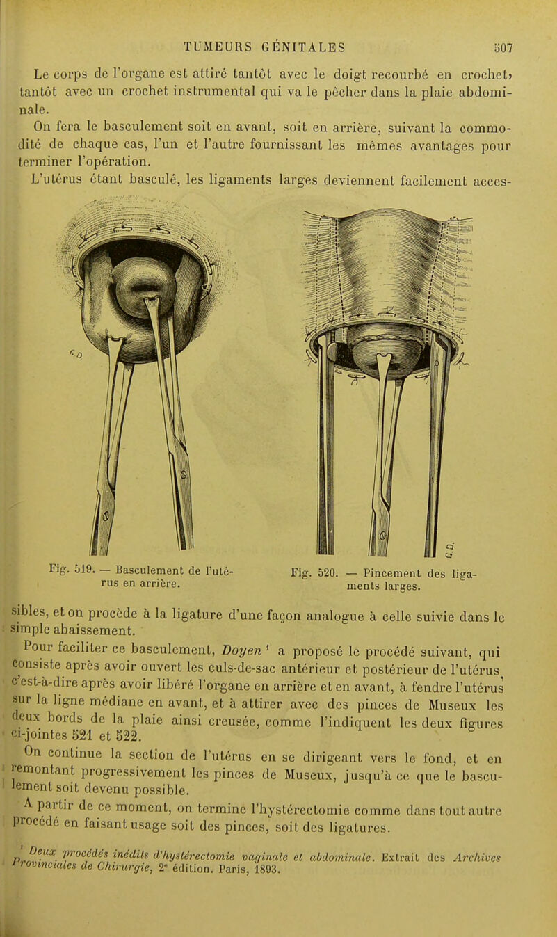 Le corps de l'organe est attiré tantôt avec le doigt recourbé en crochet» tantôt avec un crochet instrumental qui va le pécher dans la plaie abdomi- nale. On fera le basculement soit en avant, soit en arrière, suivant la commo- dité de chaque cas, l'un et l'autre fournissant les mêmes avantages pour terminer l'opération. L'utérus étant basculé, les ligaments larges deviennent facilement accès- Fig. 519. — Basculement de l'uté- rus en arrière. Fig. 520. — Pincement des liga- ments larges. sibles, et on procède à la ligature d'une façon analogue à celle suivie dans le ; simple abaissement. Pour faciliter ce basculement, Doyen 1 a proposé le procédé suivant, qui consiste après avoir ouvert les culs-de-sac antérieur et postérieur de l'utérus c'est-à-dire après avoir libéré l'organe en arrière et en avant, à fendre l'utérus sur la ligne médiane en avant, et à attirer avec des pinces de Museux les deux bords de la plaie ainsi creusée, comme l'indiquent les deux figures • ci-jointes S21 et 522. On continue la section de l'utérus en se dirigeant vers le fond, et en • remontant progressivement les pinces de Museux, jusqu'à ce que le bascu- lement soit devenu possible. A partir de ce moment, on termine l'hystércclomie comme dans tout autre procédé en faisant usage soit des pinces, soit des ligatures. P»He-UX- Proc?dds inédits d'hysléreclomie vaginale cl abdominale. Extrait des Archives ' i rovmctules de Chirurgie, 2° édition. Taris, 1893.