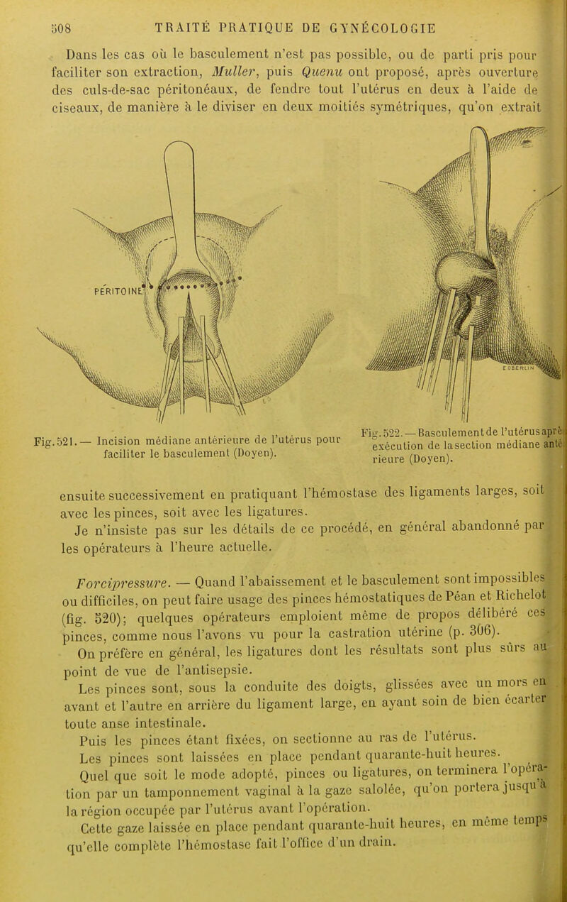 Dans les cas où le basculement n'est pas possible, ou de parti pris pour ' faciliter son extraction, Muller, puis Quenu ont proposé, après ouverture des culs-de-sac péritonéaux, de fendre tout l'utérus en deux à l'aide de ciseaux, de manière à le diviser en deux moitiés symétriques, qu'on extrait Fig.521.— Incision médiane antérieure de l'utérus pour faciliter le basculement (Doyen). Fig. 522.—Basculement de l'utérus aprè exécution de lasection médiane antè rieure (Doyen). ensuite successivement en pratiquant l'hémostase des ligaments larges, soitj avec les pinces, soit avec les ligatures. Je n'insiste pas sur les détails de ce procédé, en général abandonné pari les opérateurs à l'heure actuelle. Forcipressure. — Quand l'abaissement et le basculement sont impossibles ou difficiles, on peut faire usage des pinces hémostatiques de Péan et Richeloi (fig. 520); quelques opérateurs emploient même de propos délibéré cesj pinces, comme nous l'avons vu pour la castration utérine (p. 306). On préfère en général, les ligatures dont les résultats sont plus sûrs au point de vue de l'antisepsie. Les pinces sont, sous la conduite des doigts, glissées avec un mors en avant et l'autre en arrière du ligament large, en ayant soin de bien écarte| toute anse intestinale. Puis les pinces étant fixées, on sectionne au ras de l'utérus. Les pinces sont laissées en place pendant quarante-huit heures. ^ Quel que soit le mode adopté, pinces ou ligatures, on terminera l'opérai lion par un tamponnement vaginal à la gaze salolée, qu'on portera jusqu a la région occupée par l'utérus avant l'opération. Cette gaze laissée en place pendant quarante-huit heures, en même temps qu'elle complète l'hémostase fait l'office d'un drain.