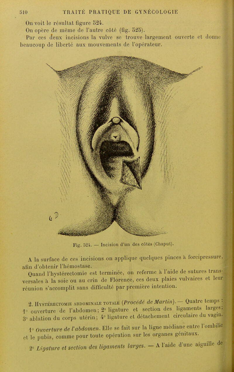 On voit le résultat figure 524. On opère de même de l'autre côté (fig. 525). Par ces deux incisions la vulve se trouve largement ouverte et donne beaucoup de liberté aux mouvements de l'opérateur. Fig. 524. — Incision d'un des côtés (Chaput). A la surface de ces incisions on applique quelques pinces à forcipressurej afin d'obtenir l'hémostase. Quand l'hystéreclomie est terminée, on referme à l'aide de sutures trans- versales à la soie ou au crin de Florence, ces deux plaies vulvaires et leur réunion s'accomplit sans difficulté par première intention. 2 Hystéhectomie abdominale totale {Procédé de Martin). — Quatre temps : lo ouverture de l'abdomen; 2° ligature et section des ligaments larges; 3° ablation du corps utérin; 4° ligature et détachement circulaire du vagiri 1° Ouverture de Vabdomen. Elle se fait sur la ligne médiane entre l'ombilic el le pubis, comme pour toute opération sur les organes génitaux. » Ligature et section des ligaments larges. - A l'aide d'une aiguille de