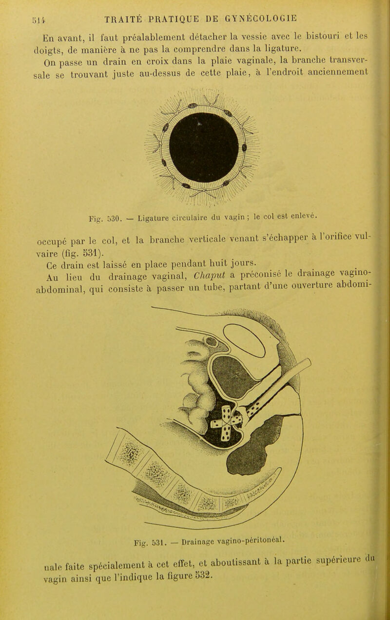 En avant, il faut préalablement détacher la vessie avec le bistouri et les doigts, de manière à ne pas la comprendre dans la ligature. On passe un drain en croix dans la plaie vaginale, la branche transver- sale se trouvant juste au-dessus de cette plaie, à l'endroit anciennement Fig. à30. — Ligature circulaire du vagin ; le col est enlevé. occupé par le col, et la branche verticale venant s'échapper à l'orifice vul- vaire (fig. 531). Ce drain est laissé en place pendant huit jours. Au lieu du drainage vaginal, Chaput a préconisé le drainage vagino- abdominal, qui consiste à passer un tube, partant d'une ouverture abdomi- Fig. 531. — Drainage vagino-péritonéal. nale faite spécialement à cet effet, et aboutissant à la partie supérieure du vagin ainsi que l'indique la figure 532.