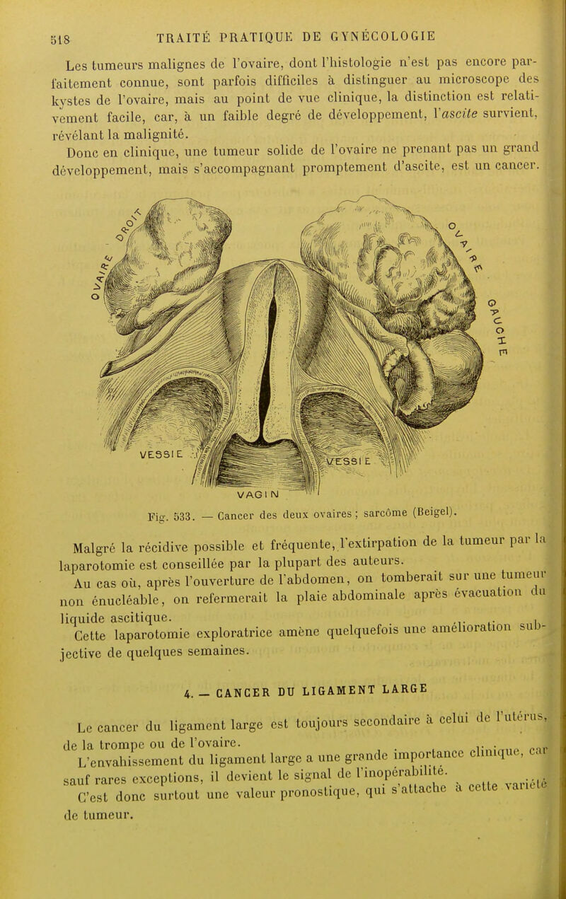 Les tumeurs malignes de l'ovaire, dont l'histologie n'est pas encore par- faitement connue, sont parfois difficiles à distinguer au microscope des kystes de l'ovaire, mais au point de vue clinique, la distinction est relati- vement facile, car, à un faible degré de développement, Yascite survient, révélant la malignité. Donc en clinique, une tumeur solide de l'ovaire ne prenant pas un grand développement, mais s'accompagnant promptement d'ascite, est un cancer. VAGI IM Fig. 533. — Cancer des deux ovaires; sarcome (Beigel). Malgré la récidive possible et fréquente, l'extirpation de la tumeur par la laparotomie est conseillée par la plupart des auteurs. Au cas où, après l'ouverture de l'abdomen, on tomberait sur une tumeur non énucléable, on refermerait la plaie abdominale après évacuation du liquide ascitique. . Cette laparotomie exploratrice amène quelquefois une amélioration sub- jective de quelques semaines. 4.- CANCER DU LIGAMENT LARGE Le cancer du ligament large est toujours secondaire à celui de l'utérus, de la trompe ou de l'ovaire. ni;n:miP pJ L'envahissement du ligament large a une grande importance clinique, car sauf rares exceptions, il devient le signal de l'inoperabihte. C'est donc surtout une valeur pronostique, qui s'attache a cette variole Je tumeur.