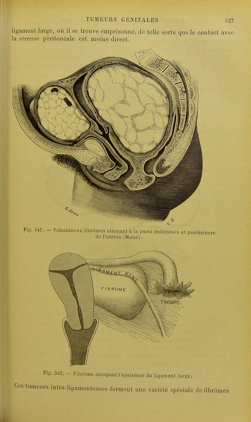 ligament large, où il se trouve emprisonné, de telle sorte que le contact avec la séreuse péritonéale est moins direct. Fie. 54J. — Volumineux fibromes attenant à la paroi antérieure et postérieure de l'utérus (Mann). Fig. 542. — Fibrome occupant l'épaisseur du ligament large. Ces tumeurs intra-ligamenteuscs forment une variété spéciale de Bbrômes