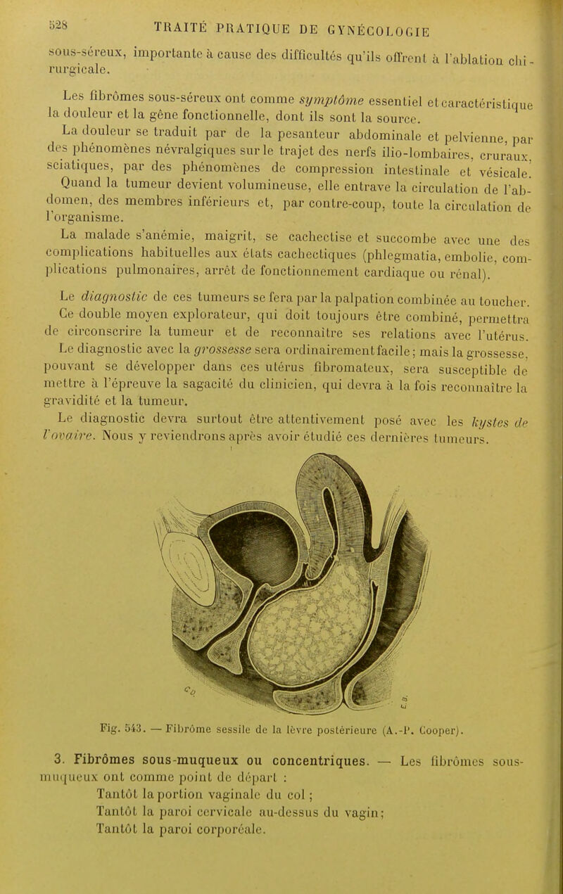 sous-séreux, importante à cause des difficultés qu'ils offrent à l'ablation chi- rurgicale. Les fibromes sous-séreux ont comme symptôme essentiel et caractéristique la douleur et la gêne fonctionnelle, dont ils sont la source La douleur se traduit par de la pesanteur abdominale et pelvienne, par des phénomènes névralgiques sur le trajet des nerfs Uio-lombaires, cruraux, sciatiques, par des phénomènes de compression intestinale et vésicale! Quand la tumeur devient volumineuse, elle entrave la circulation de l'ab- domen, des membres inférieurs et, par contre-coup, toute la circulation de l'organisme. La malade s'anémie, maigrit, se cachectise et succombe avec une des complications habituelles aux états cachectiques (phlegmatia, embolie, com- plications pulmonaires, arrêt de fonctionnement cardiaque ou rénal). Le diagnostic de ces tumeurs se fera par la palpation combinée au toucher. Ce double moyen explorateur, qui doit toujours être combiné, permettra de circonscrire la tumeur et de reconnaître ses relations avec l'utérus. Le diagnostic avec la grossesse sera orrlinairemcntfacile ; mais la grossesse pouvant se développer dans ces utérus Gbromateux, sera susceptible de mettre à l'épreuve la sagacité du clinicien, qui devra à la fois reconnaître la gravidité et la tumeur. Le diagnostic devra surtout être attentivement posé avec les kystes de l uni ire. Nous y reviendrons après avoir étudié ces dernières lumeurs. Fig. 543. — Fibrome sessile de la lèvre postérieure (À.-P. Cooper). 3. Fibromes sous-muqueux ou concentriques. — Les fibrômes sous- muqueux ont comme point de départ : Tantôt la portion vaginale du col ; Tantôt la. paroi cervicale au-dessus du vagin; Tantôt la paroi corporéale.