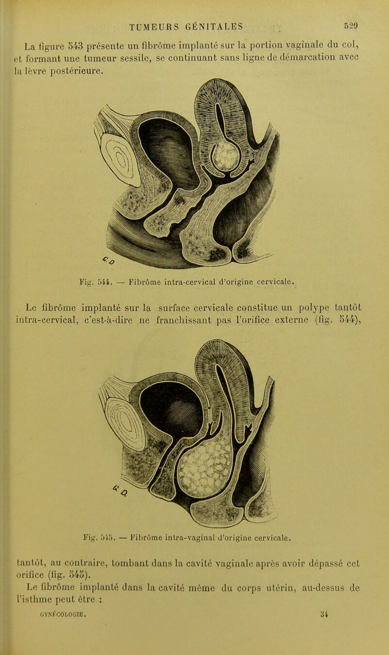 La ligure 543 présente un fibrome implanté sur la portion vaginale du col, et formant une tumeur sessilc, se continuant sans ligne de démarcation avec la lèvre postérieure. Fig. 544. — Fibrôme intra-cervical d'origine cervicale. Le fibrôme implanté sur la surface cervicale constitue un polype tantôt intra-cervical, c'est-à-dire ne franchissant pas l'orifice externe (fig. 544), tantôt, au contraire, tombant dans la cavité vaginale après avoir dépassé cet orifice (fig. 543). Le fibrôme implanté dans la cavité même du corps utérin, au-dessus de l'isthme peut être : GYNÉCOLOGIE. 34