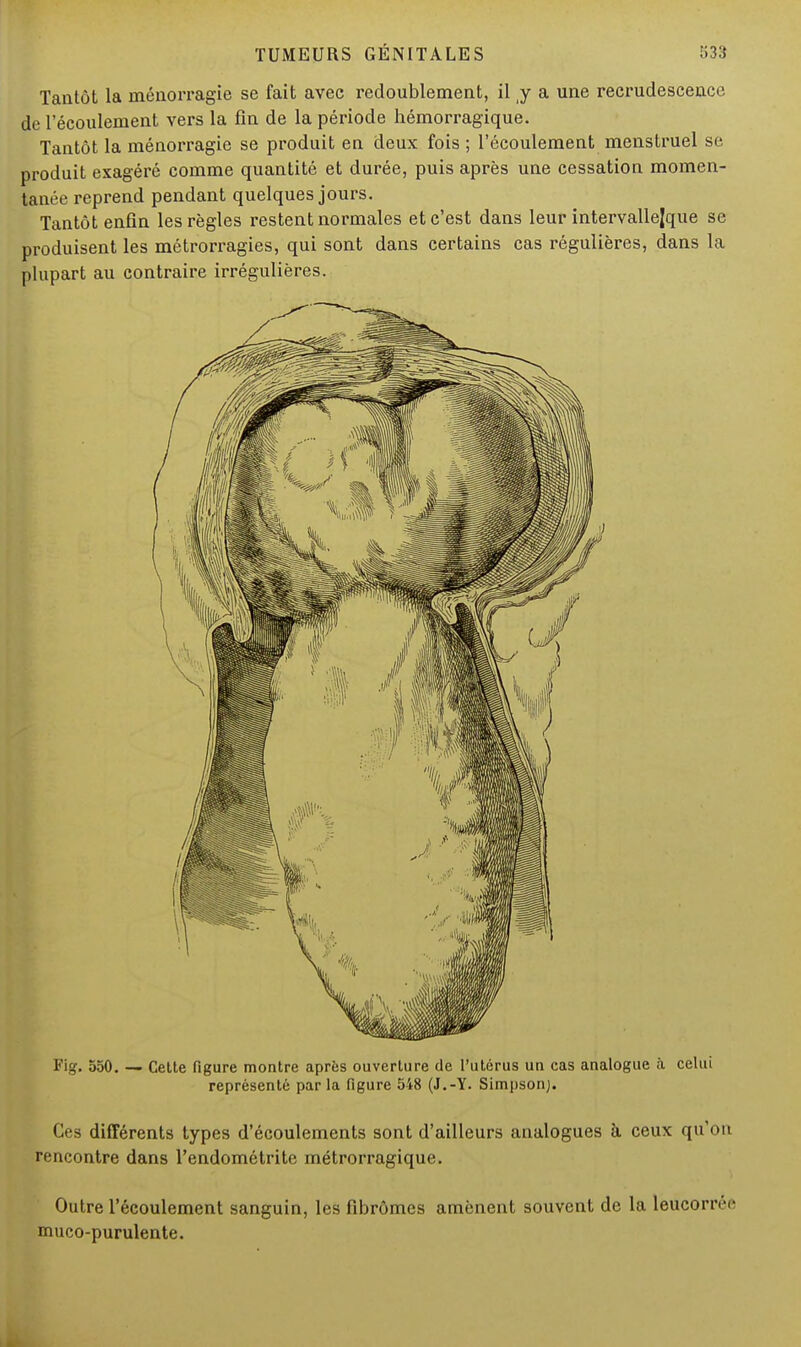 Tantôt la inénorragie se fait avec redoublement, il y a une recrudescence de l'écoulement vers la fin de la période hémorragique. Tantôt la ménorragie se produit en deux fois ; l'écoulement menstruel se produit exagéré comme quantité et durée, puis après une cessation momen- tanée reprend pendant quelques jours. Tantôt enfin les règles restent normales et c'est dans leur intervallejque se produisent les métrorragies, qui sont dans certains cas régulières, dans la plupart au contraire irrégulières. Fig. 550. — Cette figure montre après ouverture de l'utérus un cas analogue à celui représenté par la figure 548 (J.-Y. Simpson). Ces différents types d'écoulements sont d'ailleurs analogues à ceux qu'on rencontre dans l'endométrite métrorragique. Outre l'écoulement sanguin, les fibromes amènent souvent de la leucorréc muco-purulente.