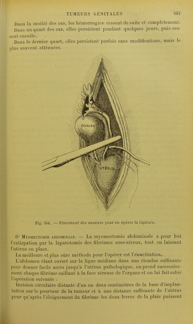 Dans la moitié des cas, les hémorragies cessent de suite et complètement. Dans un quart des cas, elles persistent pendant quelques jours, puis ces- sent ensuite. Dans le dernier quart, elles persistent parfois sans modifications, mais le plus souvent atténuées. Fig. 554. — Pincement des annexes pour en opérer la ligature. 6° Myomectomie abdominale. — La myomectomie abdominale a pour but l'extirpation par la laparotomie des fibromes sous-séreux, tout en laissant l'utérus en place. La meilleure et plus sûre méthode pour l'opérer est Yénucléation. L'abdomen étant ouvert sur la ligne médiane dans une étendue suffisante pour donner facile accès jusqu'à l'utérus pathologique, on prend successive- ment chaque fibrome saillant à la face séreuse de l'organe et on lui fait subir l'opération suivante : Incision circulaire distante d'un ou deux centimètres de la base d'implan- tation sur le pourtour de la tumeur et à une distance suffisante de l'utérus pour qu'après l'éloignernent du fibrome les deux lèvres de la plaie puissent