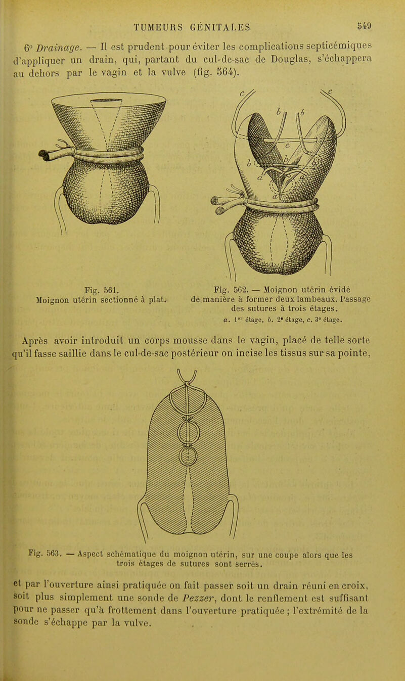 6° Drainage. — Il est prudent pour éviter les complications septicémiqtfes d'appliquer un drain, qui, partant du cul-de-sac de Douglas, s'échappera au dehors par le vagin et la vulve (fig. 564). Fig. 561. Fig. 562. — Moignon utérin évidé Moignon utérin sectionné à plat. de manière à former deux lambeaux. Passage des sutures à trois étages. a. 1er étage, b. 2* étage, c. 3° étage. Après avoir introduit un corps mousse dans le vagin, placé de telle sorte qu'il fasse saillie dans le cul-de-sac postérieur on incise les tissus sur sa pointe, Fig. 563. — Aspect schématique du moignon utérin, sur une coupe alors que les trois étages de sutures sont serrés. et par l'ouverture ainsi pratiquée on fait passer soit un drain réuni en croix, soit plus simplement une sonde de Pezzer, dont le renflement est suffisant pour ne passer qu'à frottement dans l'ouverture pratiquée ; l'extrémité de la sonde s'échappe par la vulve.