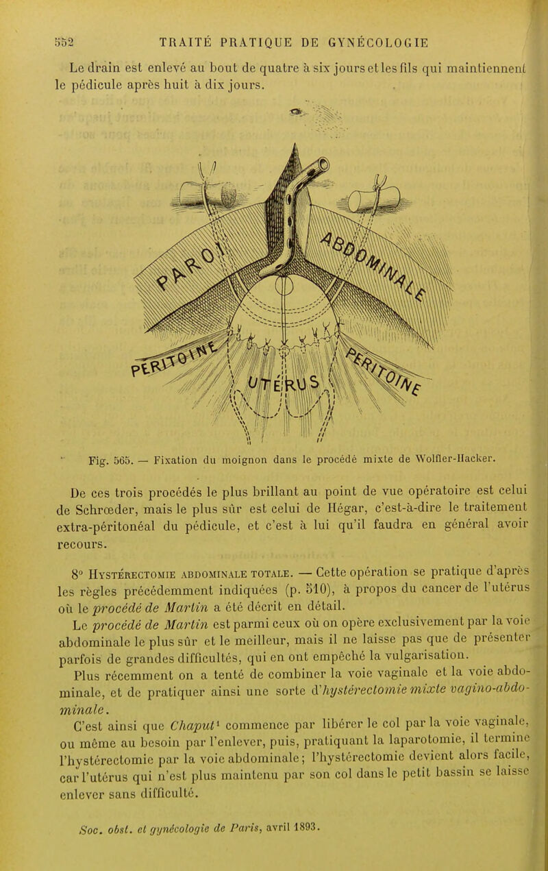 Le drain est enlevé au bout de quatre à six jours et les fils qui maintiennent le pédicule après huit à dix jours. Fig. 565. — Fixation du moignon dans le procédé mixte de Wolfler-IIacker. De ces trois procédés le plus brillant au point de vue opératoire est celui de Schrœder, mais le plus sûr est celui de Hégar, c'est-à-dire le traitement extra-péritonéal du pédicule, et c'est à lui qu'il faudra en général avoir recours. 8° Hystérectomie abdominale totale. — Cette opération se pratique d'après les règles précédemment indiquées (p. 510), à propos du cancer de l'utérus où le procédé de Martin a été décrit en détail. Le procédé de Martin est parmi ceux où on opère exclusivement par la voie abdominale le plus sûr et le meilleur, mais il ne laisse pas que de présenter parfois de grandes difficultés, qui en ont empêché la vulgarisation. Plus récemment on a tenté de combiner la voie vaginale et la voie abdo- minale, et de pratiquer ainsi une sorte Xhystérectomie mixte vagino-abdu- minale. C'est ainsi que Chapul1 commence par libérer le col parla voie vaginale, ou même au besoin par l'enlever, puis, pratiquant la laparotomie, il termine l'hystérectomie par la voie abdominale ; l'hystérectomie devient alors facile, car l'utérus qui n'est plus maintenu par son col dans le petit bassin se laisse enlever sans difficulté. Soc. obst. cl gynécologie de Paris, avril 1893.