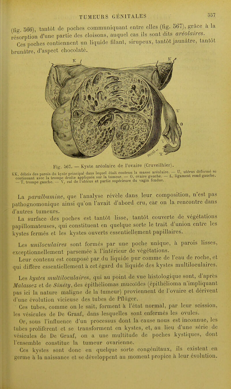 (li„ 566) tantôt de poches communiquant entre elles (fig. 567), grâce à la résorption d'une partie des cloisons, auquel cas ils sont dits aréolaires. Ces poches contiennent un liquide filant, sirupeux, tantôt jaunâtre, tantôt brunâtre, d'aspect chocolaté. Fig. 567. — Kyste arèolaire de l'ovaire (Cmveilhier). KK débris des narois du kyste principal dans lequel était contenu la masse arèolaire. — U, utérus déformé se ^Z^J^^ITZ^ appliquée sur la tumeur. - 0 ovaire gauche. - L, bgament rond gauche. — T, trompe gauche. — V, col de l'utérus et partie supérieure du vagin lendue. La paralbumine, que l'analyse révèle dans leur composition, n'est pas pathognomonique ainsi qu'on l'avait d'abord cru, car on la rencontre dans d'autres tumeurs. La surface des poches est tantôt lisse, tantôt couverte de végétations papillomateuses, qui constituent en quelque sorte le trait d'union entre les kystes fermés et les kystes ouverts essentiellement papillaires. Les uniloculaires sont formés par une poche unique, à parois lisses, exceptionnellement parsemée à l'intérieur de végétations. Leur contenu est composé par du liquide pur comme de l'eau de roche, et qui diffère essentiellement à cet égard du liquide des kystes multiloculaires. Les kystes multiloculaires, qui au point de vue histologique sont, d'après Malassez et de Sinéty, des épithéliomas mucoïdes (épithélioma n'impliquant pas ici la nature maligne de la tumeur) proviennent de l'ovaire et dérivent d'une évolution vicieuse des tubes de Pfliiger. Ces tubes, comme on le sait, forment à l'état normal, par leur scission, 1rs vésicules de De Graaf, dans lesquelles sont enfermés les ovules. Or, sous l'influence d'un processus dont la cause nous est inconnue, les tubes prolifèrent et se transforment en kystes, et, au lieu d'une série de vésicules de De Graaf, on a une multitude de poches kystiques, dont l'ensemble constitue la tumeur ovarienne. Ces kystes sont donc en quelque sorte congénitaux, ils existent en germe à la naissance et se développent au moment propice à leur évolution.