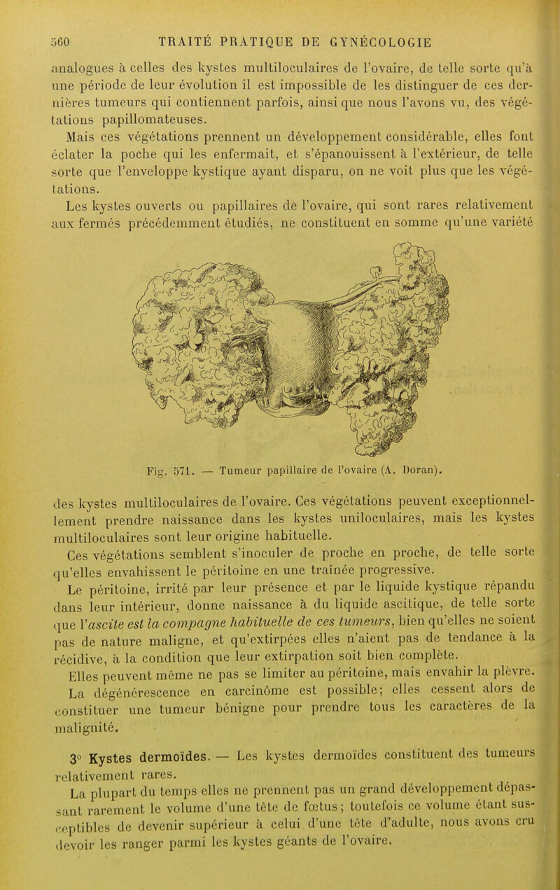 analogues à celles des kysles multiloculaires de l'ovaire, de telle sorte qu'à une période de leur évolution il est impossible de les distinguer de ces der- nières tumeurs qui contiennent parfois, ainsi que nous l'avons vu. des végé- tations papillomateuses. Mais ces végétations prennent un développement considérable, elles font éclater la poche qui les enfermait, et s'épanouissent à l'extérieur, de telle sorte que l'enveloppe kystique ayant disparu, on ne voit plus que les végé- tations. Les kystes ouverts ou papillaires de l'ovaire, qui sont rares relativement aux fermés précédemment étudiés, ne constituent en somme qu'une variété Fig. 571. — Tumeur papillaire de l'ovaire (A. Doran). des kystes multiloculaires de l'ovaire. Ces végétations peuvent exceptionnel- lement prendre naissance dans les kystes uniloculaires, mais les kystes multiloculaires sont leur origine habituelle. Ces végétations semblent s'inoculer de proche en proche, de telle sorte qu'elles envahissent le péritoine en une traînée progressive. Le péritoine, irrité par leur présence et par le liquide kystique répandu dans leur intérieur, donne naissance à du liquide ascitique, de telle sorte que Vascite est la compagne habituelle de ces tumeurs, bien qu'elles ne soient pas de nature maligne, et qu'extirpées elles n'aient pas de tendance à la récidive, à la condition que leur extirpation soit bien complète. Elles peuvent même ne pas se limiter au péritoine, mais envahir la plèvre. La dégénérescence en carcinome est possible; elles cessent alors de constituer une tumeur bénigne pour prendre tous les caractères de la malignité. 3° Kystes dermoïdes. — Les kystes dermoïdes constituent des tumeurs relativement rares. La plupart du temps elles ne prennent pas un grand développement dépas- sant rarement le volume d'une tête de fœtus; toutefois ce volume étant sus- ceptibles de devenir supérieur à celui d'une tète d'adulte, nous avons crû devoir les ranger parmi les kystes géants de l'ovaire.