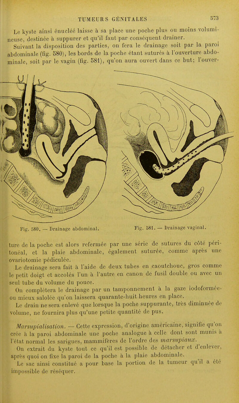 Le kyste ainsi énucléé laisse à sa place une poche plus ou moins volumi- neuse, destinée à suppurer et qu'il faut par conséquent drainer. Suivant la disposition des parties, on fera le drainage soit par la paroi abdominale (fîg. 580), les bords de la poche étant suturés à l'ouverture abdo- minale, soit par le vagin (fig. S81), qu'on aura ouvert dans ce but; l'ouver- ture de la poche est alors refermée par une série de sutures du côté péri- tonéal, et la plaie abdominale, également suturée, comme après une ovariotomie pédiculée. Le drainage sera fait à l'aide de deux tubes en caoutchouc, gros comme le petit doigt et accolés l'un à l'autre en canon de fusil double ou avec un seul tube du volume du pouce. On complétera le drainage par un tamponnement à la gaze iodoformée- ou mieux salolce qu'on laissera quarante-huit heures en place. Le drain ne sera enlevé que lorsque la poche suppurante, très diminuée de volume, ne fournira plus qu'une petite quantité de pus. Marsupialisation. — Cette expression, d'origine américaine, signifie qu'on crée à la paroi abdominale une poche analogue à celle dont sont munis à l'état normal les sarigues, mammifères de l'ordre des marsupiaux. On extrait du kyste tout ce qu'il est possible de détacher et d'enlever, après quoi on fixe la paroi de la poche à la plaie abdominale. Le sac ainsi constitué a pour base la portion de la tumeur qu'il a été impossible de réséquer.