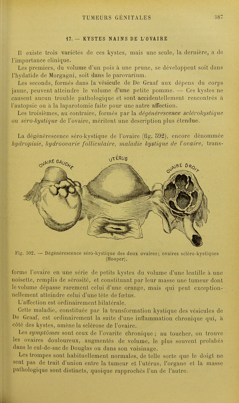 17. — KYSTES NAINS DE L'OVAIRE Il existe trois variétés de ces kystes, mais une seule, la dernière, a de l'importance clinique. Les premiers, du volume d'un pois à une prune, se développent soit dans l'hydatide de Morgagni, soit dans le parovarium. Les seconds, formés dans la vésicule de De Graaf aux dépens du corps jaune, peuvent atteindre le volume d'une petite pomme. — Ces kystes ne causent aucun trouble pathologique et sont accidentellement rencontrés à l'autopsie ou à la laparotomie faite pour une autre affection. Les troisièmes, au contraire, formés par la dégénérescence sclérokystique ou séro-kystique de l'ovaire, méritent une description plus étendue. La dégénérescence séro-kystique de l'ovaire (fig. 592), encore dénommée hydropisie, hydroovarie folliculaire, maladie kystique de l'ovaire, trans- Fig. 592. — Dégénérescence séro-kystique des deux ovaires; ovaires scléro-kystiques (Hooper). forme l'ovaire en une série de petits kystes du volume d'une lentille à une noisette, remplis de sérosité, et constituant par leur masse une tumeur dont le volume dépasse rarement celui d'une orange, mais qui peut exception- nellement atteindre celui d'une tête de fœtus. L'affection est ordinairement bilatérale. Cette maladie, constituée par la transformation kystique des vésicules de De Graaf, est ordinairement la suite d'une inflammation chronique qui, à côté des kystes, amène la sclérose de l'ovaire. Les symptômes sont ceux de l'ovarite chronique; au toucher, on trouve les ovaires douloureux, augmentés de volume, le plus souvent prolabés dans le cul-de-sac de Douglas ou dans son voisinage. Les trompes sont habituellement normales, de telle sorte que le doigt ne sent pas de trait d'union entre la tumeur et l'utérus, l'organe et la masse pathologique sont distincts, quoique rapprochés l'un de l'autre.