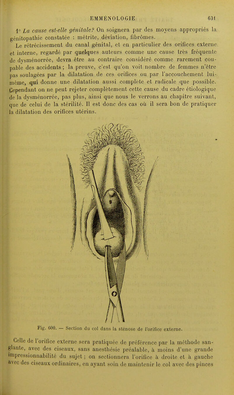 1° La cause est-elle génitale? On soignera par des moyens appropriés la génitopathie constatée : métrite, déviation, fibromes. Le rétrécissement du canal génital, et en particulier des orifices externe et interne, regardé par quelques auteurs comme une cause très fréquente de dysménorrée, devra être au contraire considéré comme rarement cou- pable des accidents ; la preuve, c'est qu'on voit nombre de femmes n'être pas soulagées par la dilatation de ces orifices ou par l'accouchement lui- même, qui donne une dilatation aussi complète et radicale que possible. Cependant on ne peut rejeter complètement cette cause du cadre étiologique de la dysménorrée, pas plus, ainsi que nous le verrons au chapitre suivant, que de celui de la stérilité. Il est donc des cas où il sera bon de pratiquer la dilatation des orifices utérins. Fig. 600. — Section du col dans la sténose de l'orifice externe. Celle de l'orifice externe sera pratiquée de préférence par la méthode san- glante, avec des ciseaux, sans anesthésie préalable, à moins d'une grande impressionnabilité du sujet ; on sectionnera l'orifice à droite et à gauche avec des ciseaux ordinaires, en ayant soin de maintenir le col avec des pinces