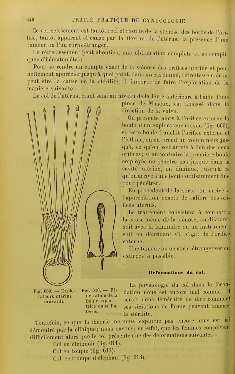 Ce rétrécissement est tantôt réel et résulte de la sténose des bords de l'ori- fice, tantôt apparent et causé par la flexion de l'utérus, la présence d'une tumeur ou d'un corps étranger. Le rétrécissement peut aboutir à une oblitération complète et se compli- quer d'hématométrie. Pour se rendre un compte exact de la sténose des orifices utérins et pour nettement apprécier jusqu'à quel point, dans un cas donné, l'étroitesse utérine peut être la cause de la stérilité, il importe de faire l'exploration de la manière suivante : Le col de l'utérus, étant saisi au niveau de la lèvre antérieure à l'aide d'une pince de Museux, est abaissé dans la direction de la vulve. On présente alors à l'orifice externe la boule d'un explorateur moyen (fig. G09), si cette boule franchit l'orifice externe et l'isthme, on en prend un volumineux jus- qu'à ce qu'on soit arrêté à l'un des deux orifices ; si au contraire la première boule employée ne pénètre pas jusque dans la cavité utérine, on diminue, jusqu'à ce qu'on arrive à une boule suffisamment fine pour pénétrer. En procédant'de la sorte, on arrive à l'appréciation exacte de calibre des ori- fices utérins. Le traitement consistera à combattre la cause même de la sténose, en dilatant, soit avec la laminaire ou un instrument, soit en débridant s'il s'agit de l'orifice externe. Une tumeur ou un corps étranger seront extirpés si possible. Déformations tin col. - Explo- rateurs utérins (Auvard). Fig. 610. — Pé- nétration delà boule explora- trice dans l'u- térus. La physiologie du col dans la fécon- dation nous est encore mal connue ; il serait donc téméraire de dire comment ses viciations de forme peuvent amener la stérilité. Toutefois, ce que la théorie ne nous explique pas encore nous est ici démontré par la clinique; nous savons, en effet, que les femmes conçoivent difficilement alors que le col présente une des déformations suivantes : Col en éteignoir (fig. 611). Col en toupie (fig. 612). Col en trompe d'éléphant (fig 618).