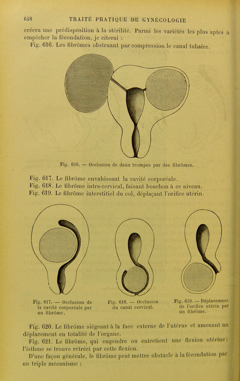 créera une prédisposition à la stérilité. Parmi les variétés les plus aptes à empêcher la fécondation, je citerai : Fig. 616. Les fibromes obstruant par compression le canal tubaire. Fig. 616. — Occlusion de deux trompes par des fibromes. Fig. 617. Le fibrome envahissant la cavité corporéale. Fig. 618. Le fibrome intra-cervical, faisant bouchon à ce niveau. Fig. 619. Le fibrome interstitiel du col, déplaçant l'orifice utérin. Fig. 617. — Occlusion de Fig. 618. — Occlusion Fig. 619. — Déplacement la cavité corporéale par du canal cervical. de l'orifice utérin par un fibrôme. un fibrome. Fig. 620. Le fibrôme siégeant à la face externe de l'utérus et amenant un déplacement en totalité de l'organe. Fig. 621. Le fibrôme, qui engendre ou entretient une flexion utérine; l'isthme se trouve rétréci par cette flexion. D'une façon générale, le fibrôme peut mettre obstacle à la fécondation par un triple mécanisme :