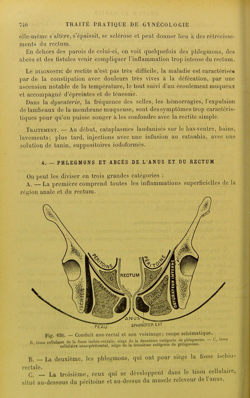 elle-même s'altère, s'épaissit, se sclérose et peut donner lieu à des rétrécisse- ments du rectum. En dehors des parois de celui-ci, on voit quelquefois des phlegmons, des abcès et des fistules venir compliquer l'inflammation trop intense du rectum. Le diagnostic de rectite n'est pas très difficile, la maladie est caractérisée par de la constipation avec douleurs très vives à la défécation, par une ascension notable de la température, le tout suivi d'un écoulement muqueux et accompagné d'épreintes et de ténesme. Dans la dysenterie, la fréquence des selles, les hémorragies, l'expulsion de lambeaux de la membrane muqueuse, sont des symptômes trop caractéris- tiques pour qu'on puisse songer aies confondre avec la rectite simple. Traitement. — Au début, cataplasmes laudanisés sur le bas-ventre, bains, lavements; plus tard, injections avec une infusion au ratanhia, avec une solution de tanin, suppositoires iodoformés. 4. — PHLEGMONS ET ABCÈS DE L'ANUS ET DU RECTUM On peut les diviser en trois grandes catégories : A. — La première comprend toutes les inflammations superficielles de la région anale et du rectum. PÉÂO SPHINCTER EXT Fig. 636. — Conduit ano-rectal et son voisinage; coupe schématique. V, lissu cellulaire de la fosse iscl.io-rectalc, siège do la deuxième catégorie de phlegmons. - C, tissu cellulaire sous-périlonôal, siège de la troisième catégorie de phlegmons. fc. — La deuxième, les phlegmons, qui ont pour siège la fosse ischio- rcctîxlc. G. — La troisième, ceux qui se développent dans le tissu cellulaire, situé au-dessous du péritoine et au-dessus du muscle rcleveur de l'anus.